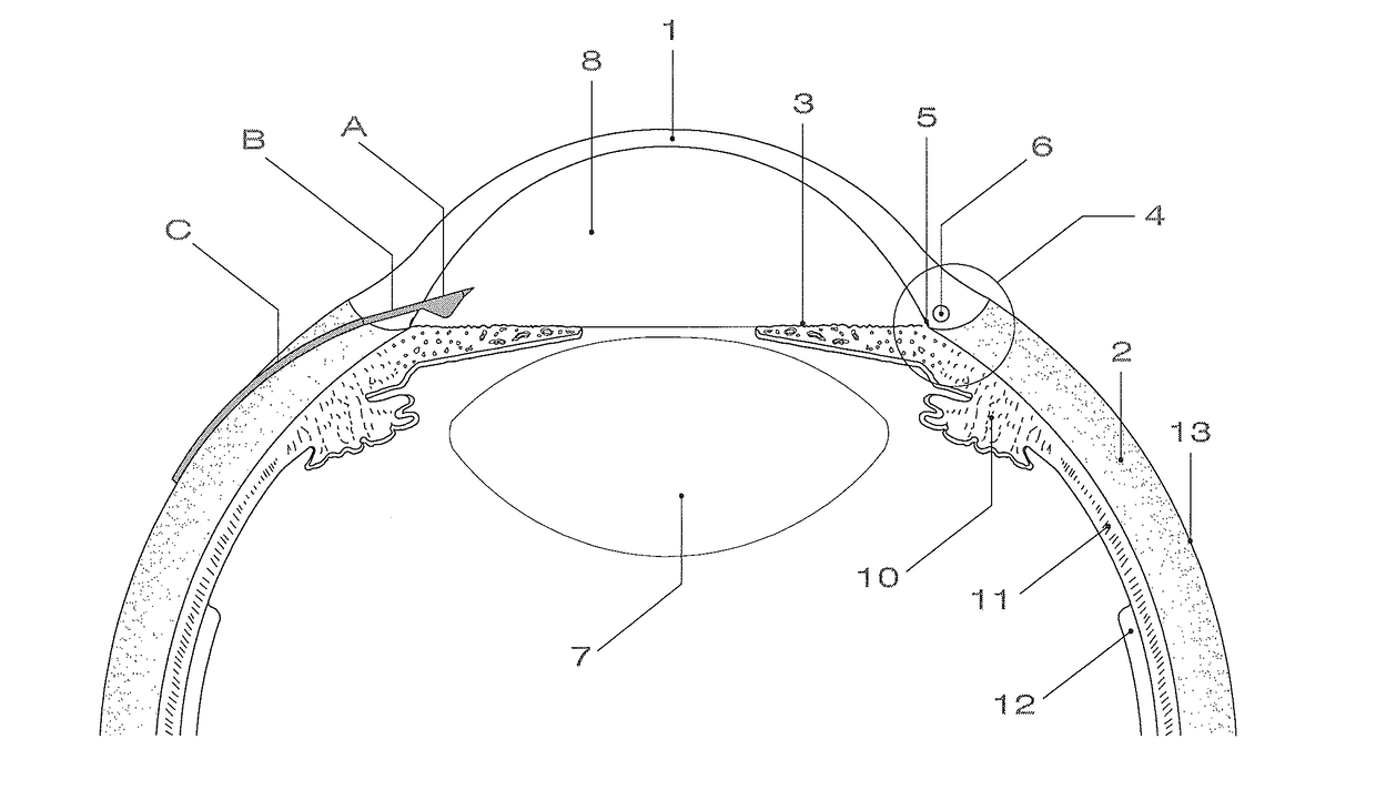 One piece flat device of for the drainage of aqueous humor from the eye