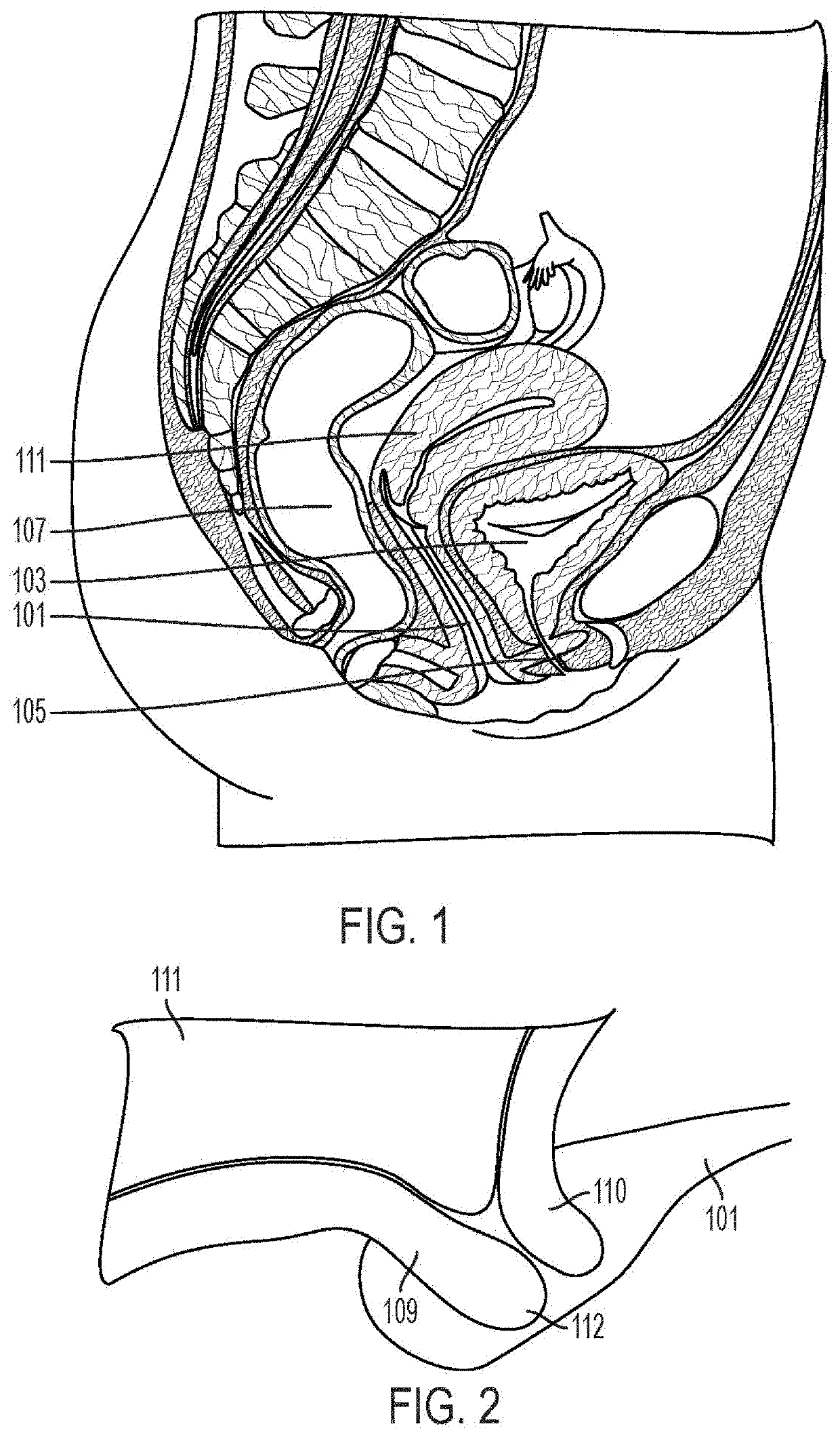 Wireless power for pessary device