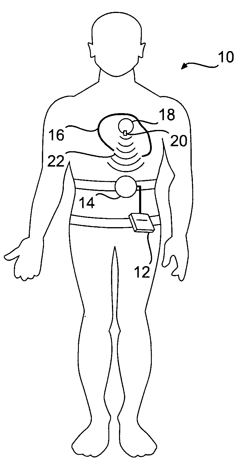 Implantable pressure monitor