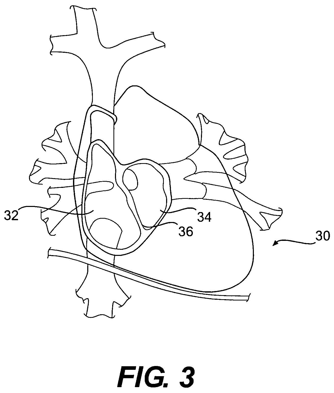 Implantable pressure monitor