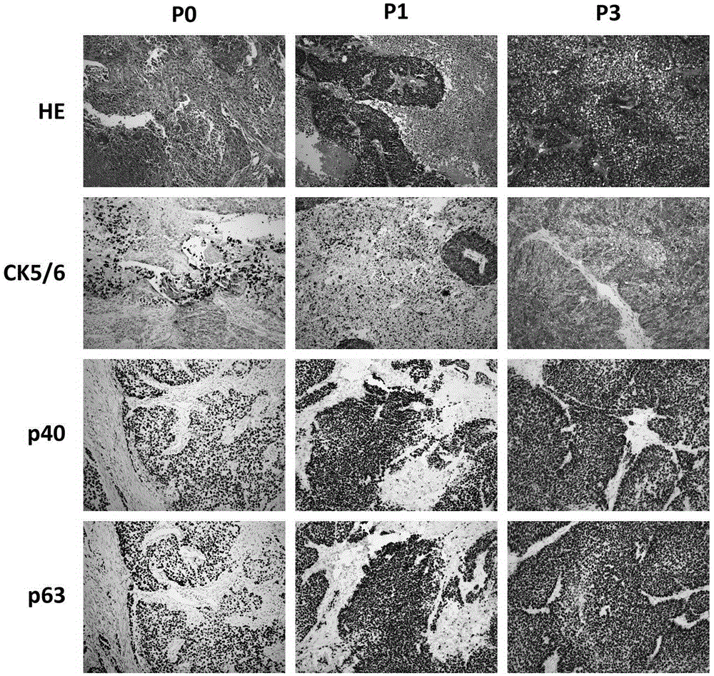 Method for constructing non-small-cell lung cancer gefitinib drug-resistance PDX model