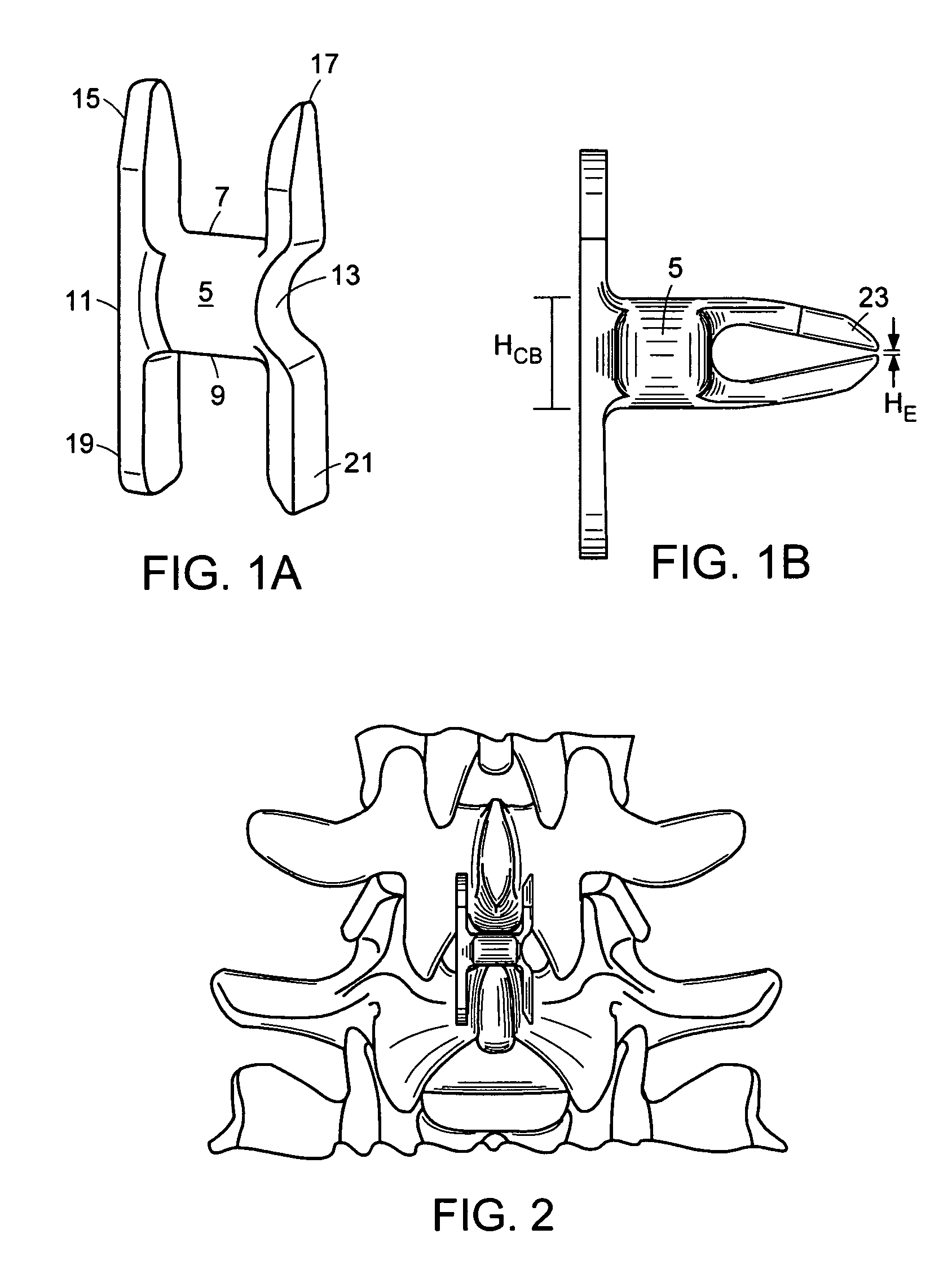 Posterior process dynamic spacer