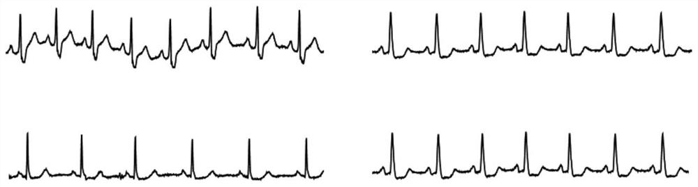 Embedded child electrocardiogram monitoring equipment and system