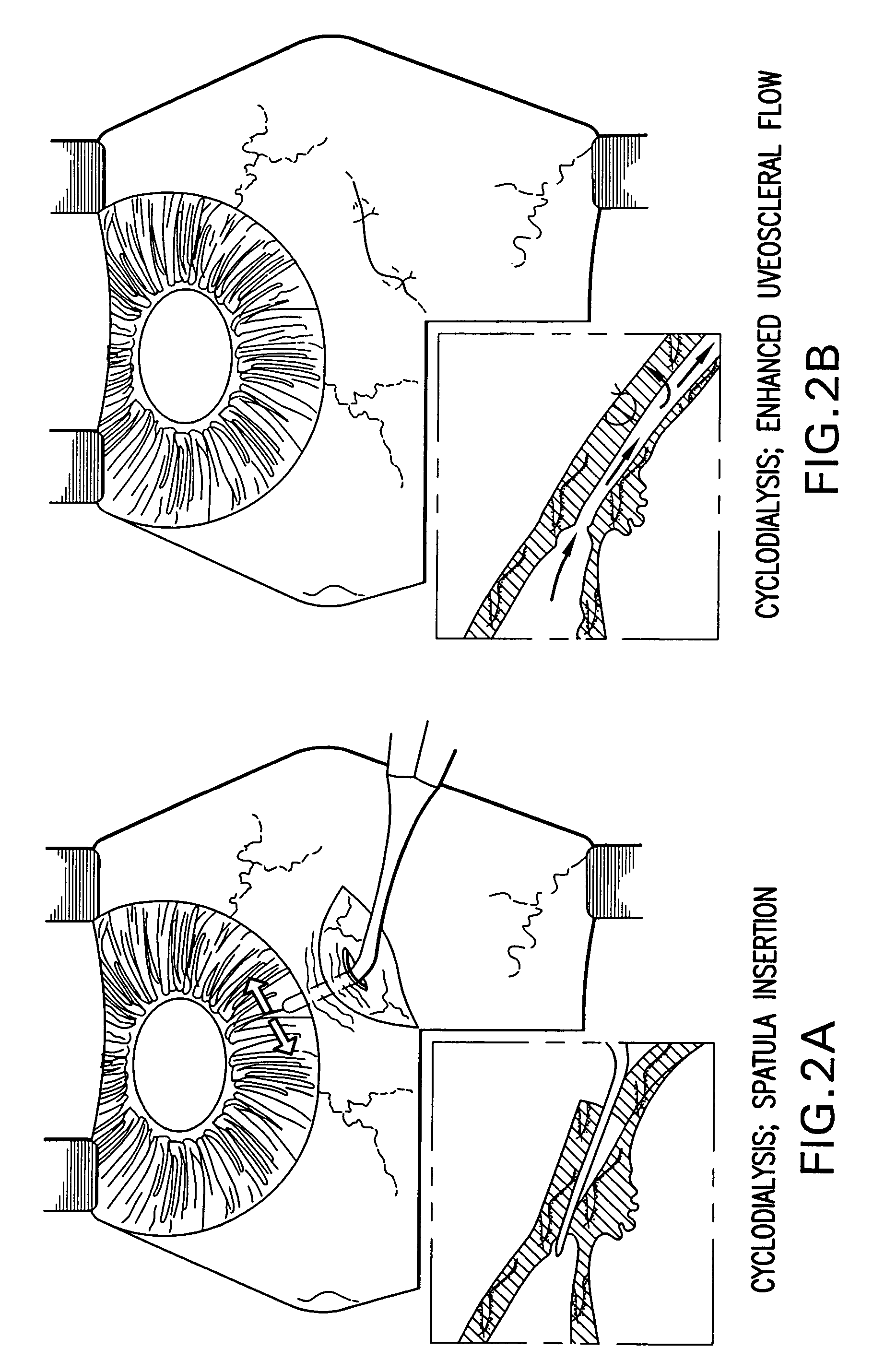 Uveoscleral drainage device