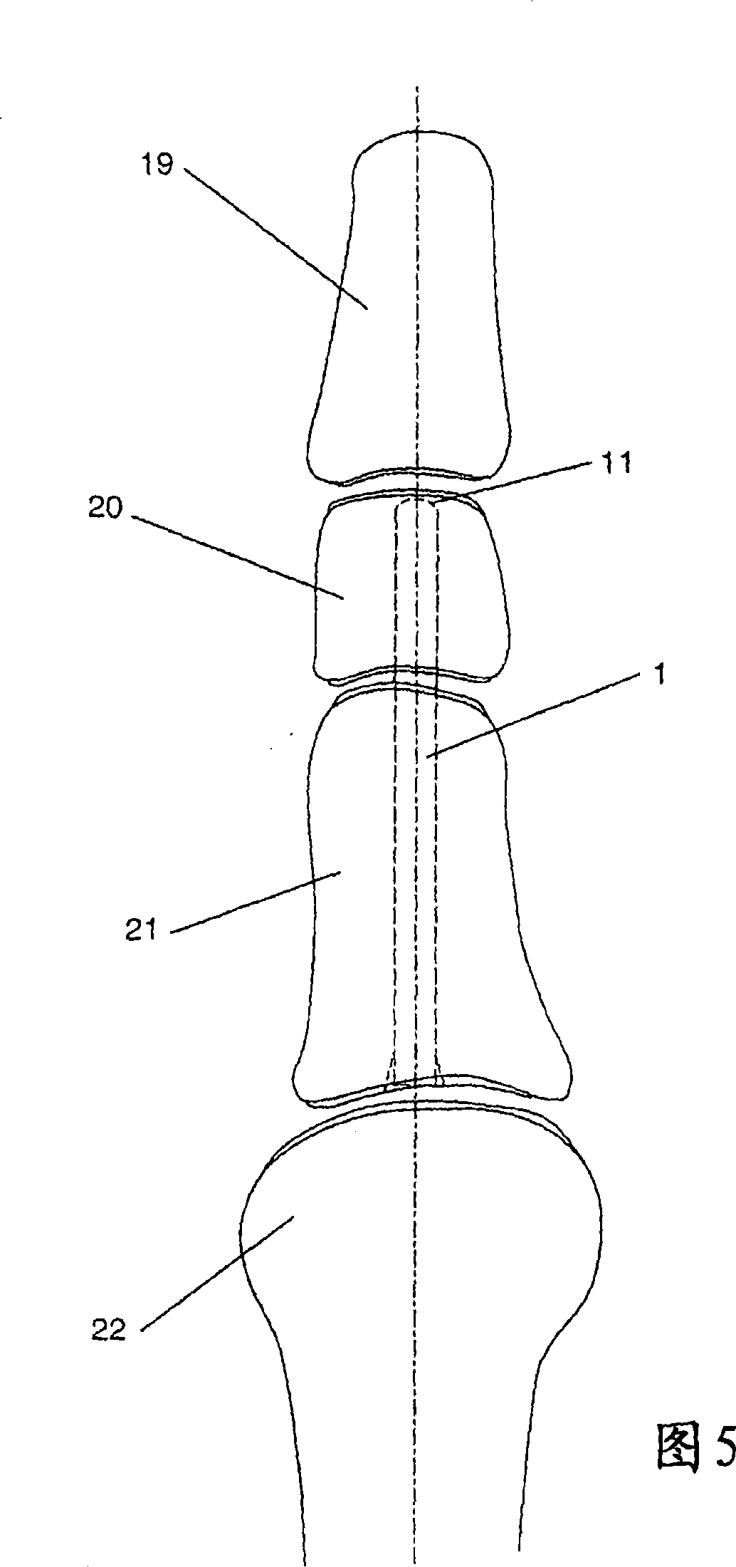 Osteosynthesis device