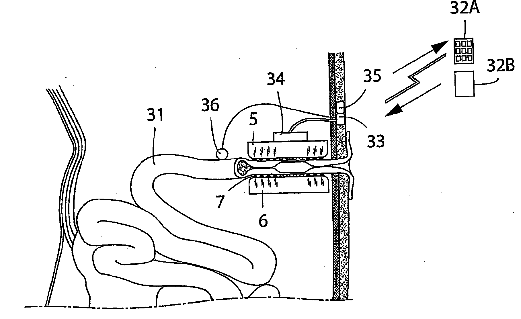 Ostomy accessory