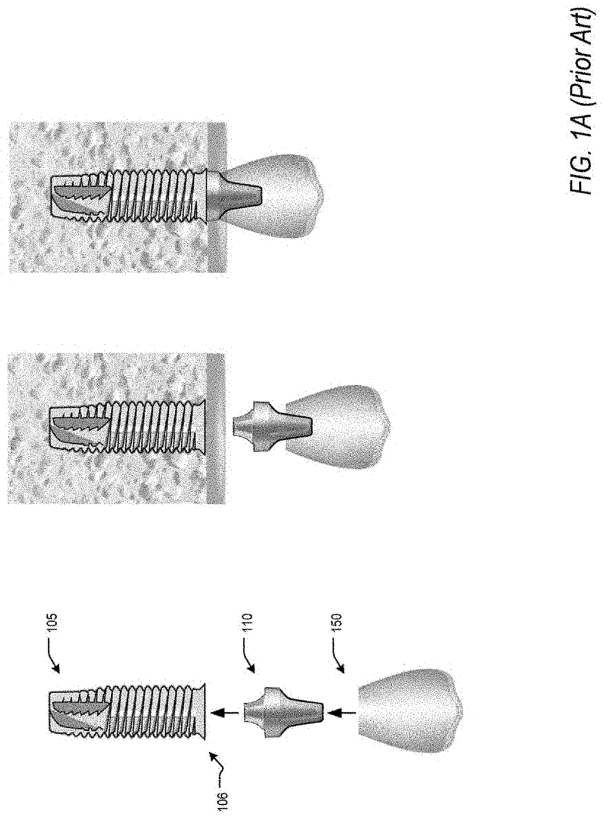 Apparatus and method for a transalveolar dental implant