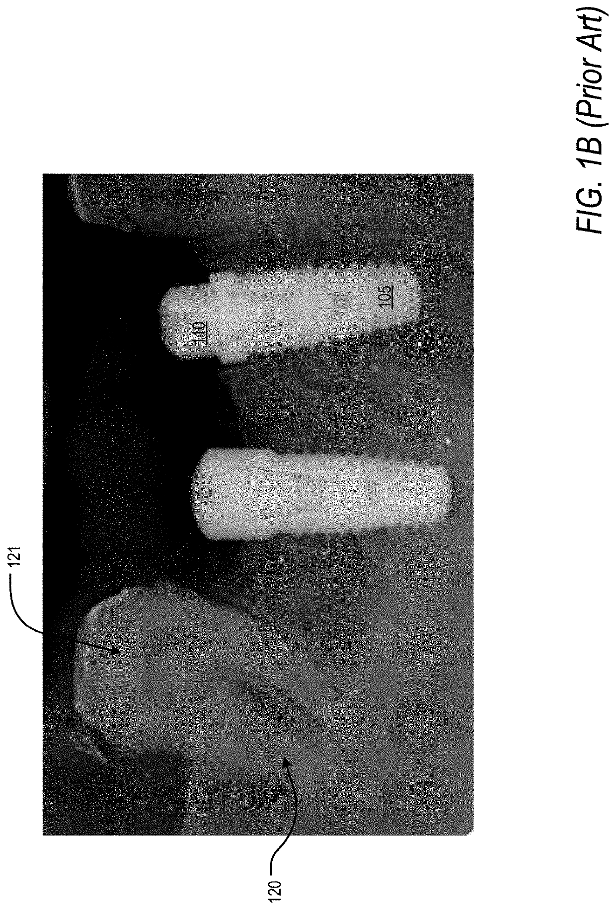 Apparatus and method for a transalveolar dental implant