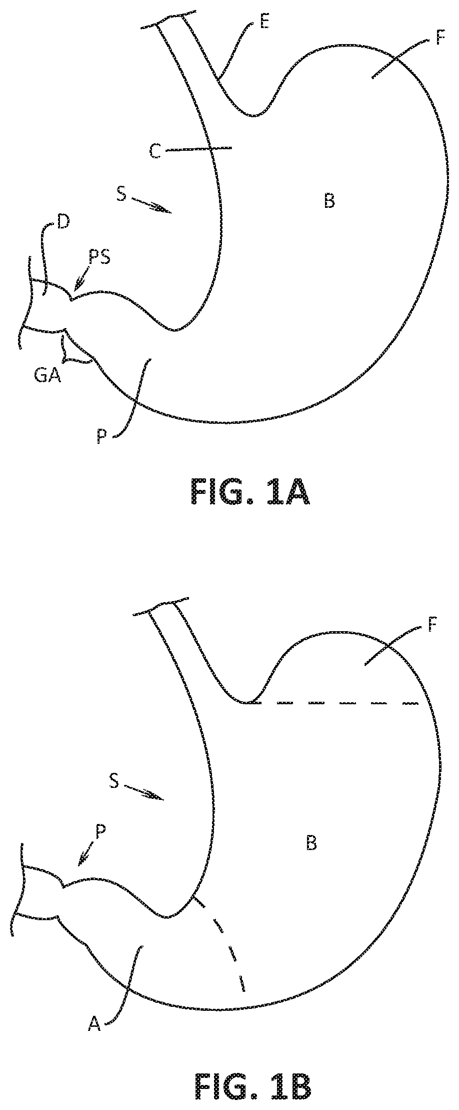 Devices, systems, and methods for delivering therapeutic agents into a stomach wall