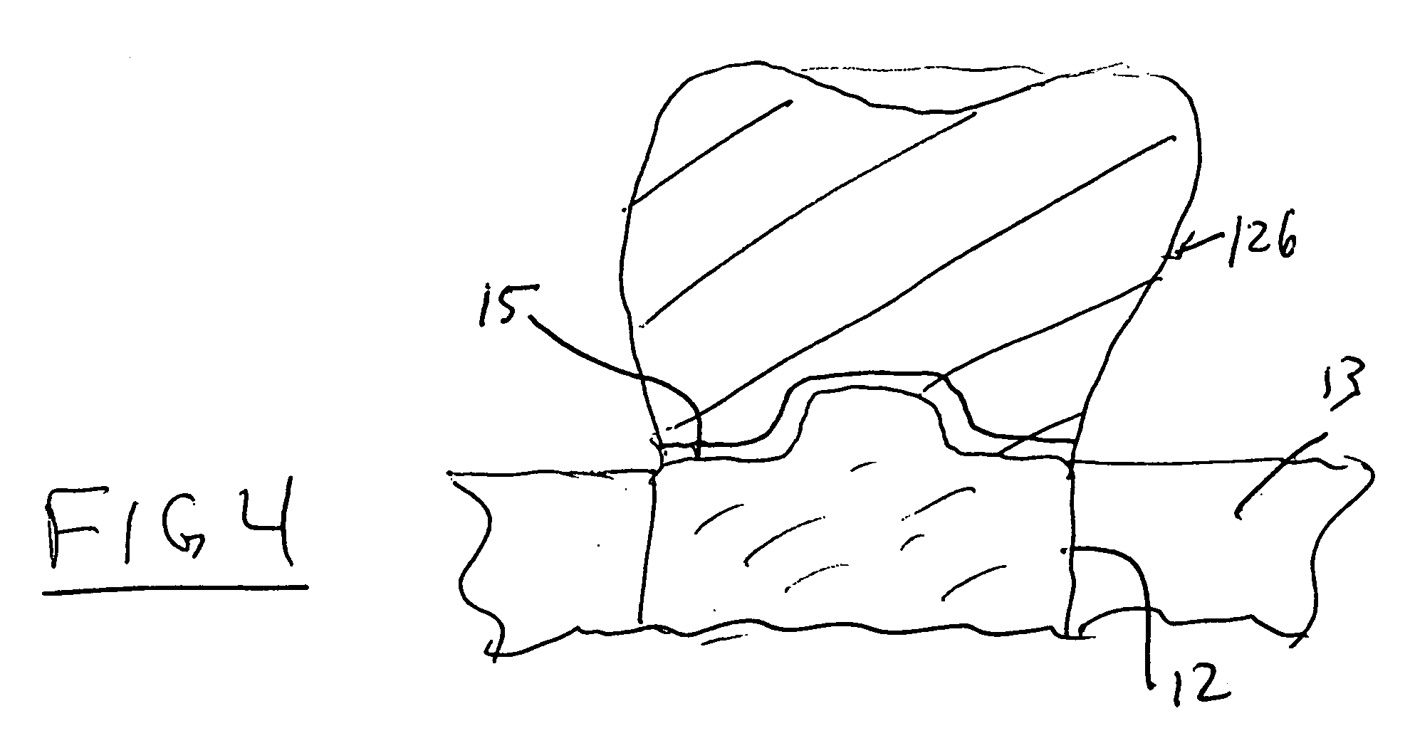 Dental crown composed of anodized titanium