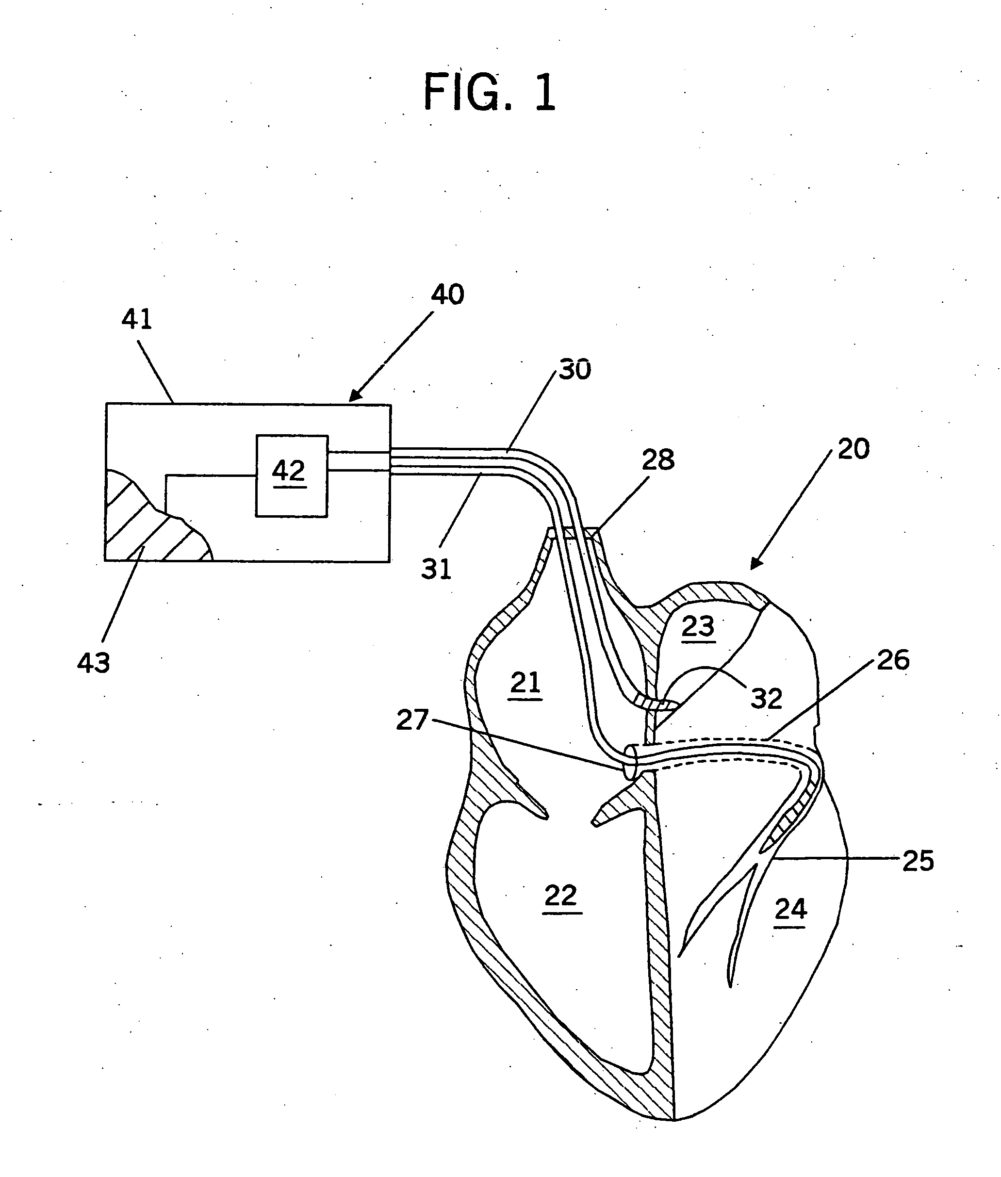 Inter-atrial septum or superior vena cava electrodes for atrial defibrillation