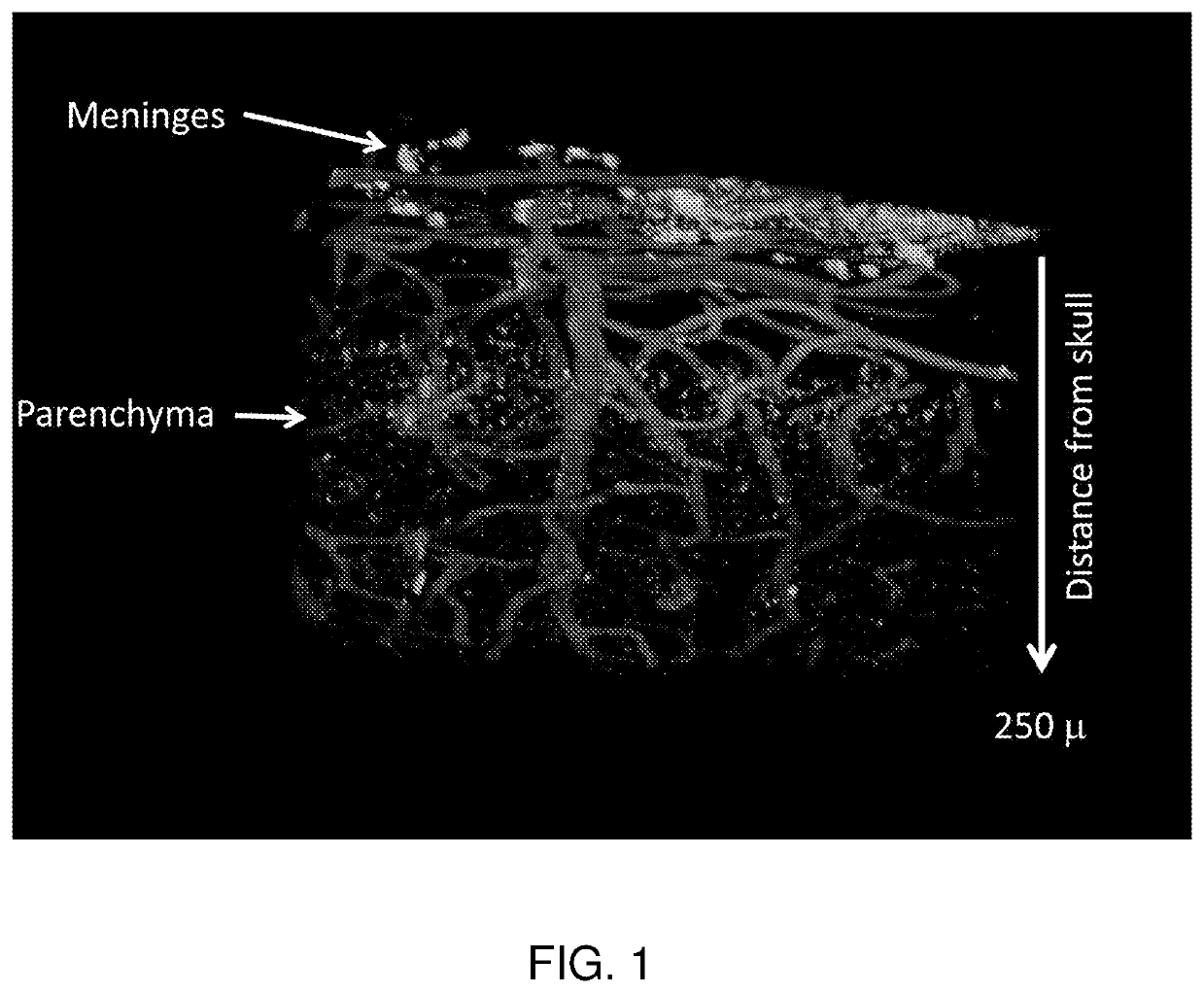 Methods for the treatment of leptomeningeal carcinomatosis