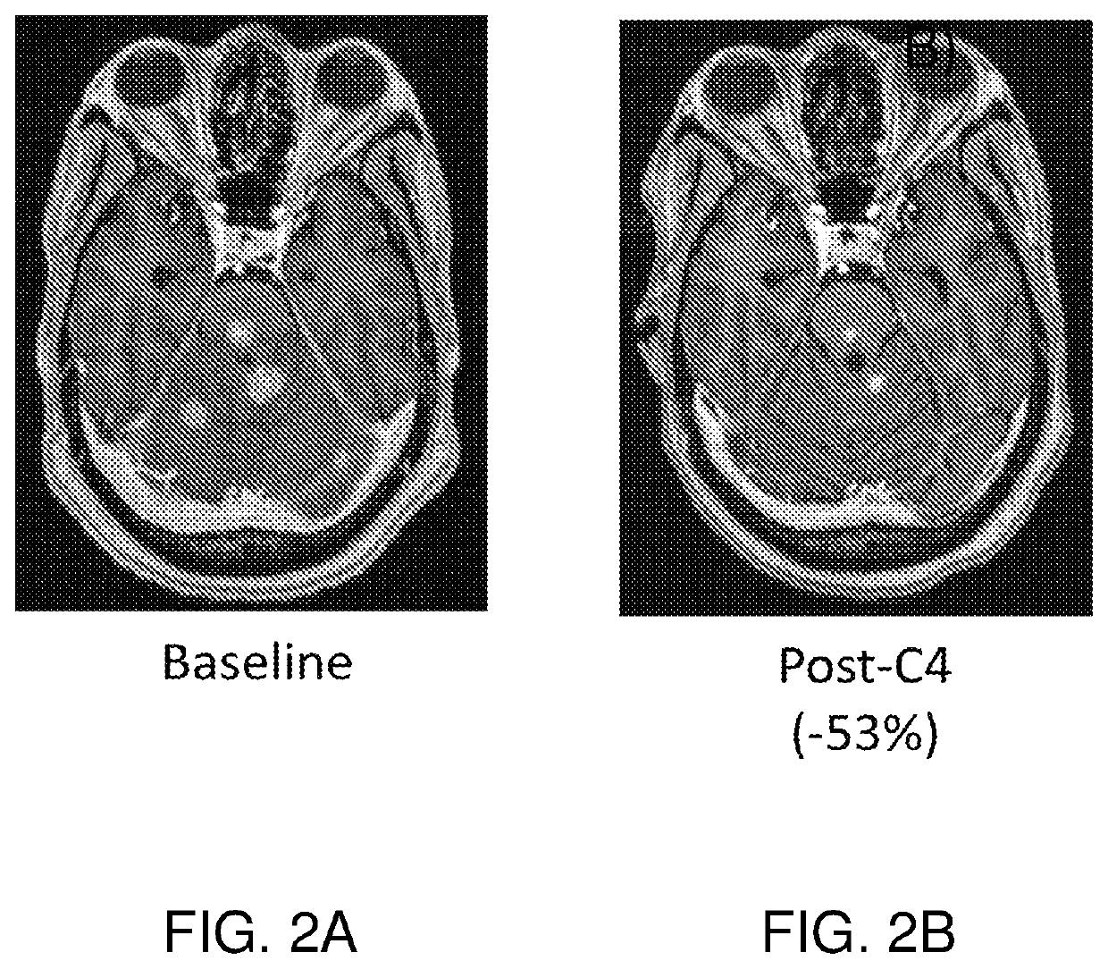 Methods for the treatment of leptomeningeal carcinomatosis