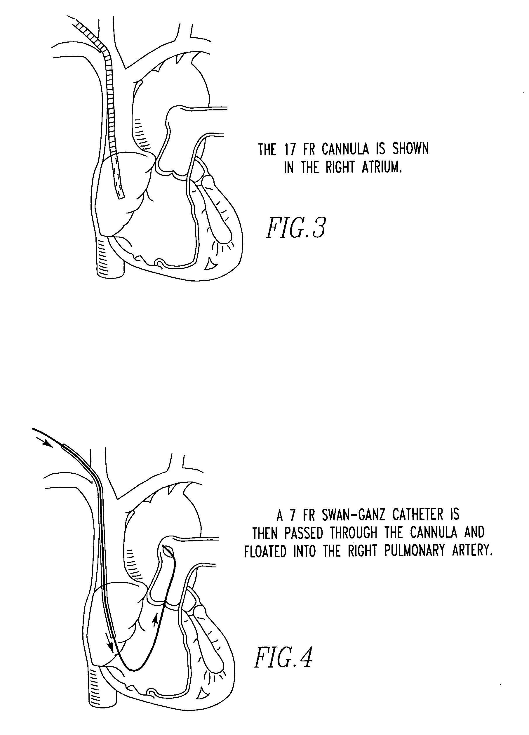 Percutaneous right ventricular assist apparatus and method