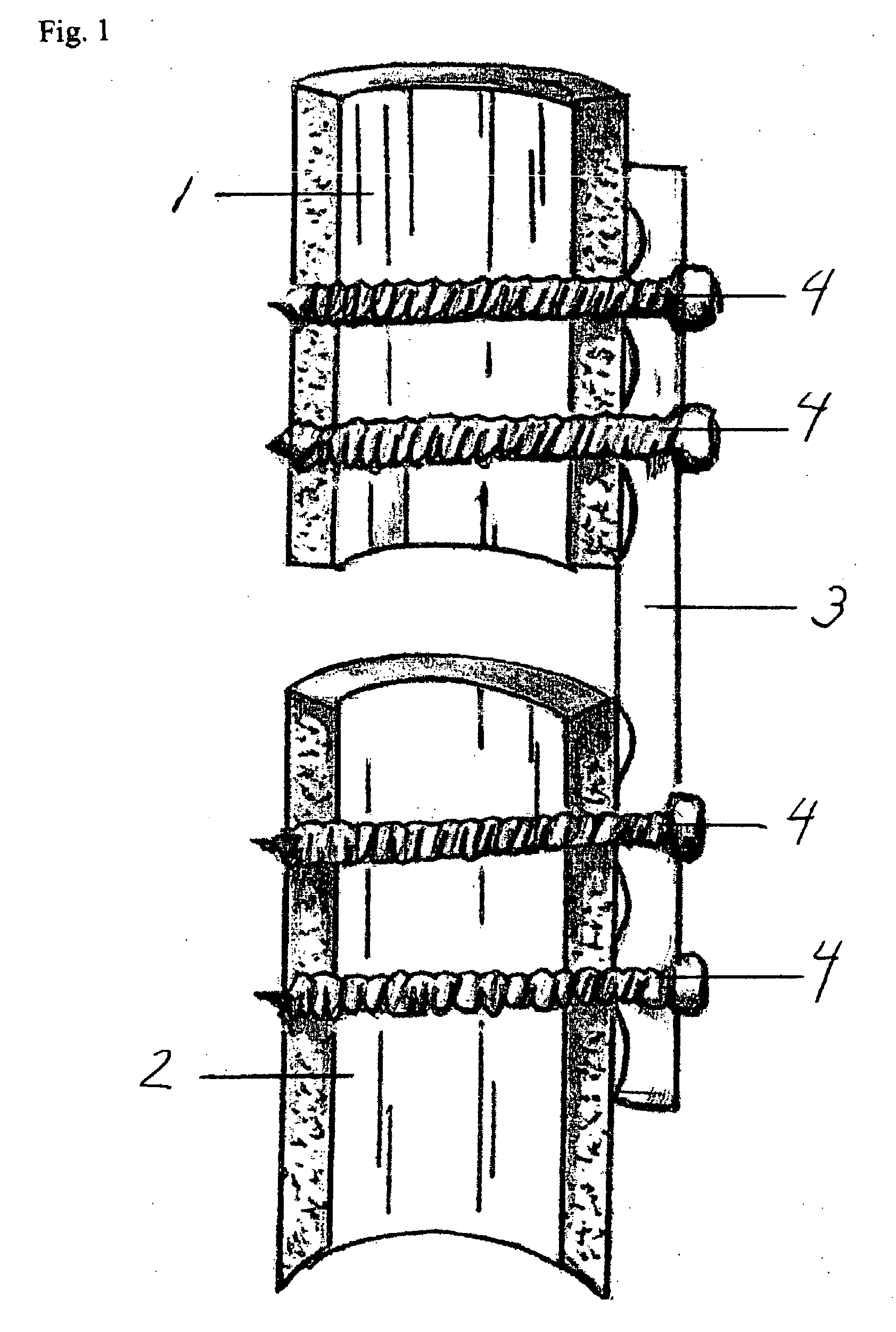 Bone plating system for treatment of hip fractures