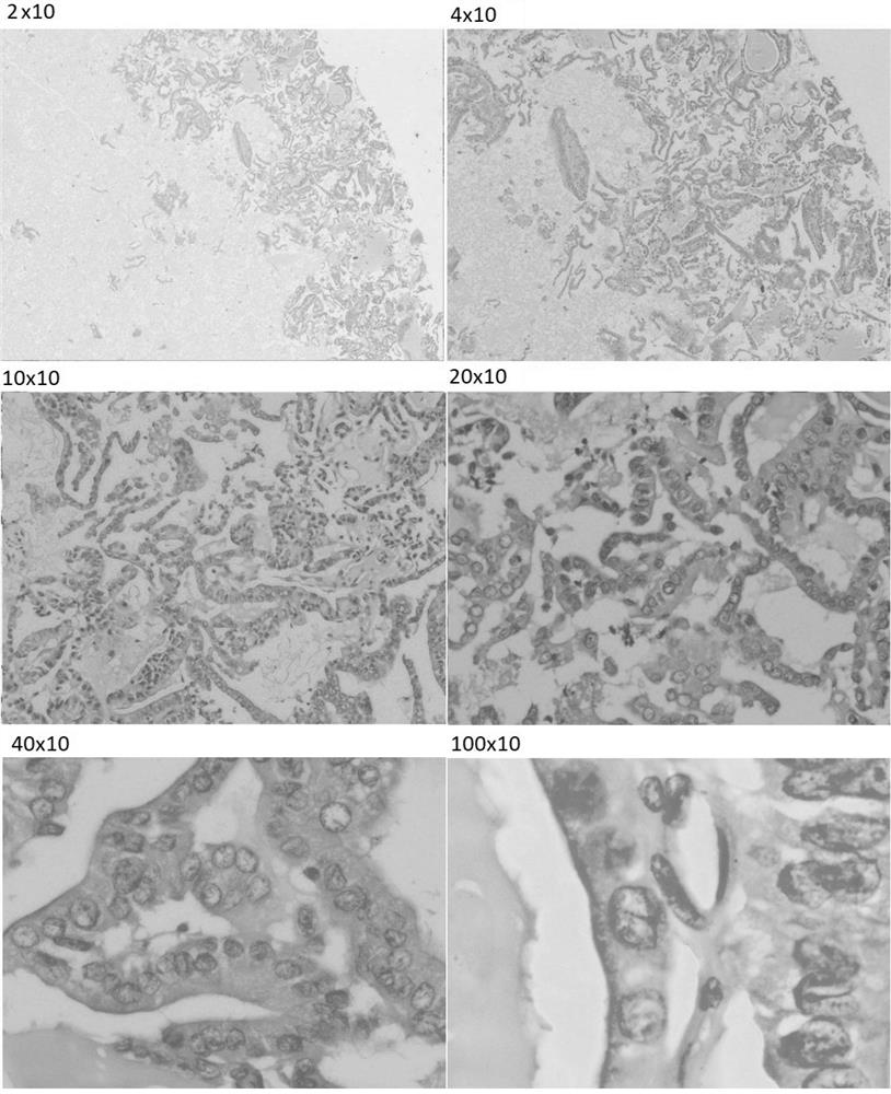 A method for preparing thyroid and breast fine-needle aspiration cell tissue block