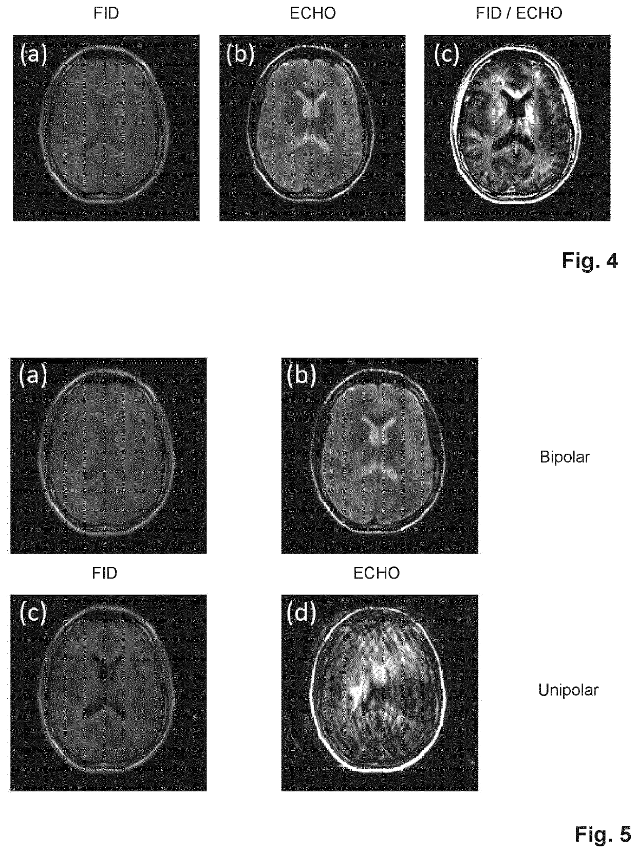 Dual echo steady state mr imaging using bipolar diffusion gradients