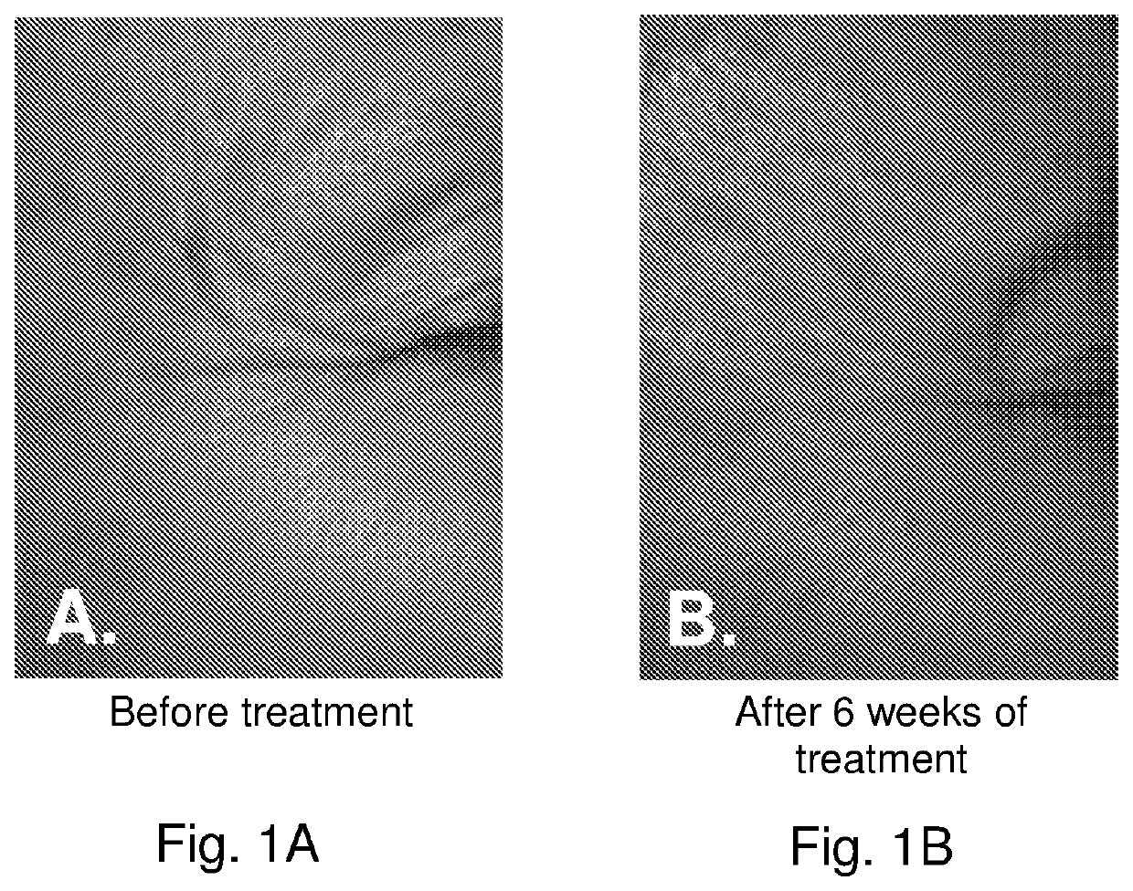 Stem cell stimulating compositions and methods of treating melasma