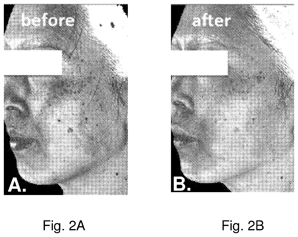 Stem cell stimulating compositions and methods of treating melasma