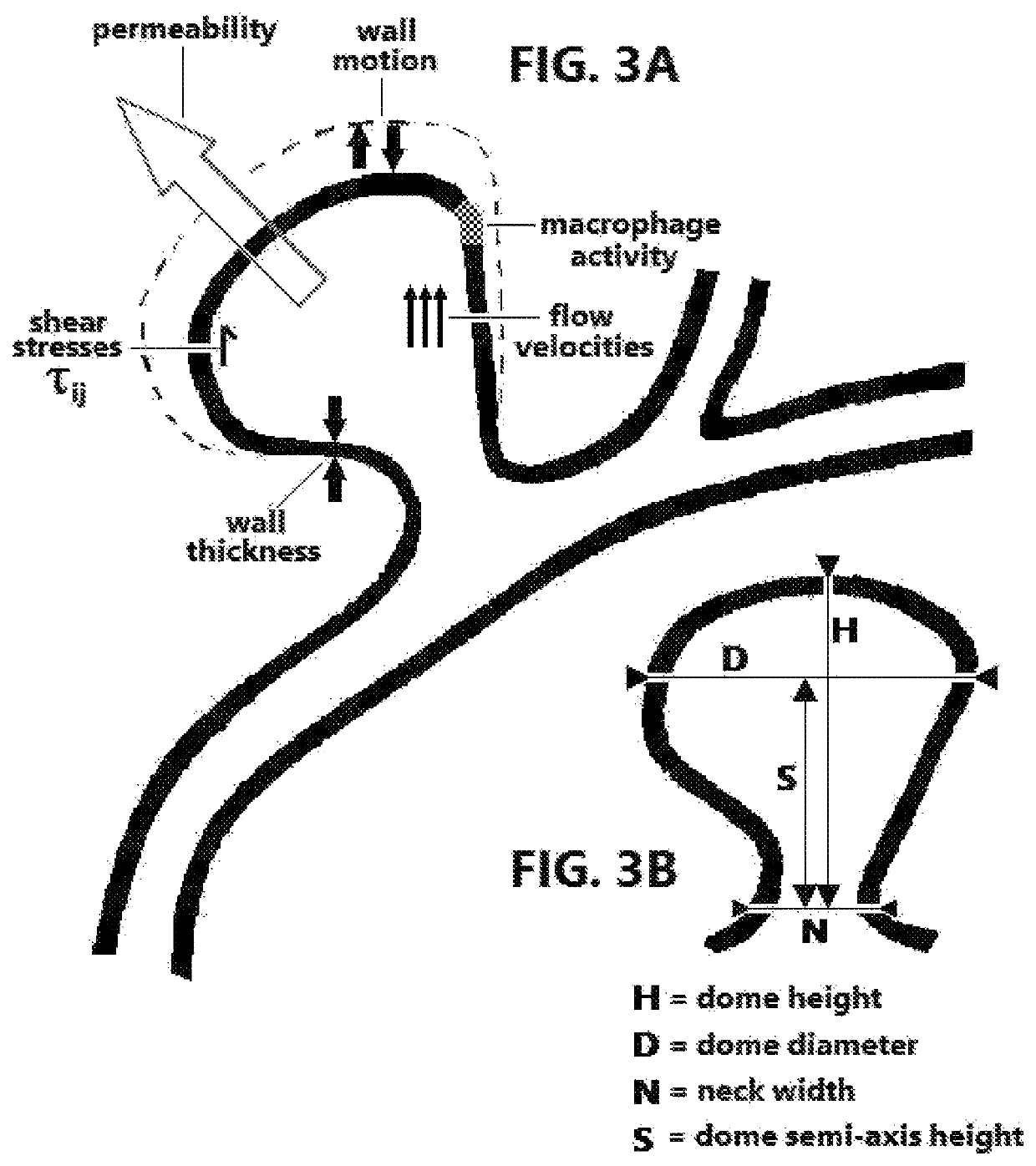 Treatment of unruptured saccular intracranial aneurysms using stereotactic radiosurgery