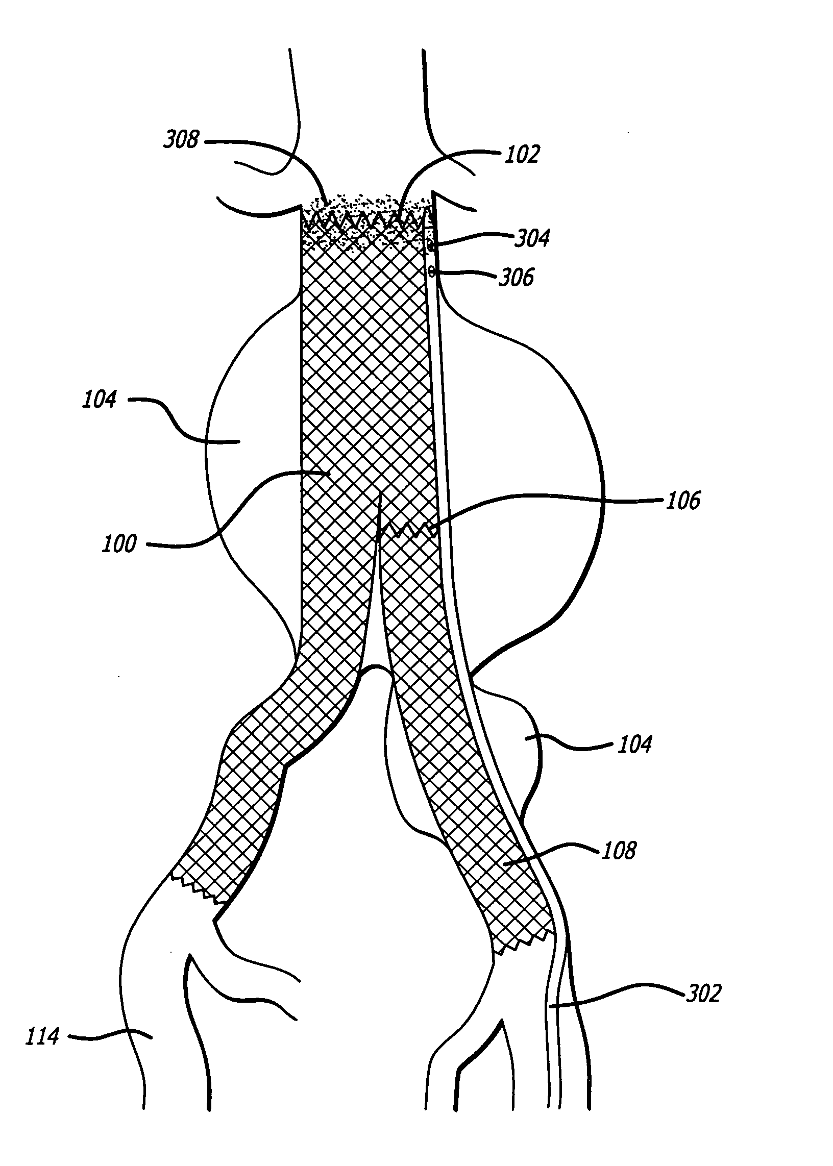 Autologous platelet gel on a stent graft