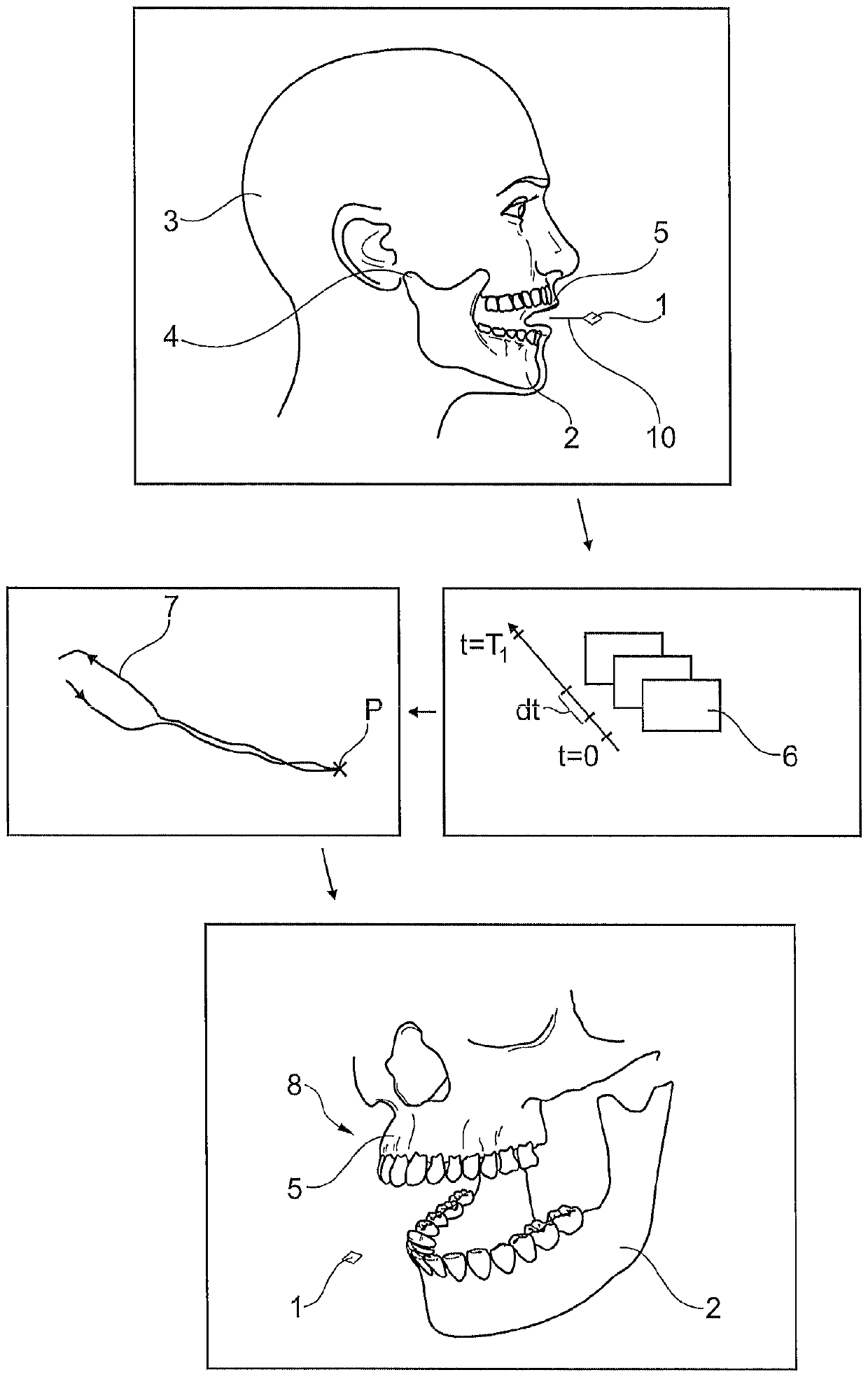 Method for detecting the movement of a temporomandibular joint