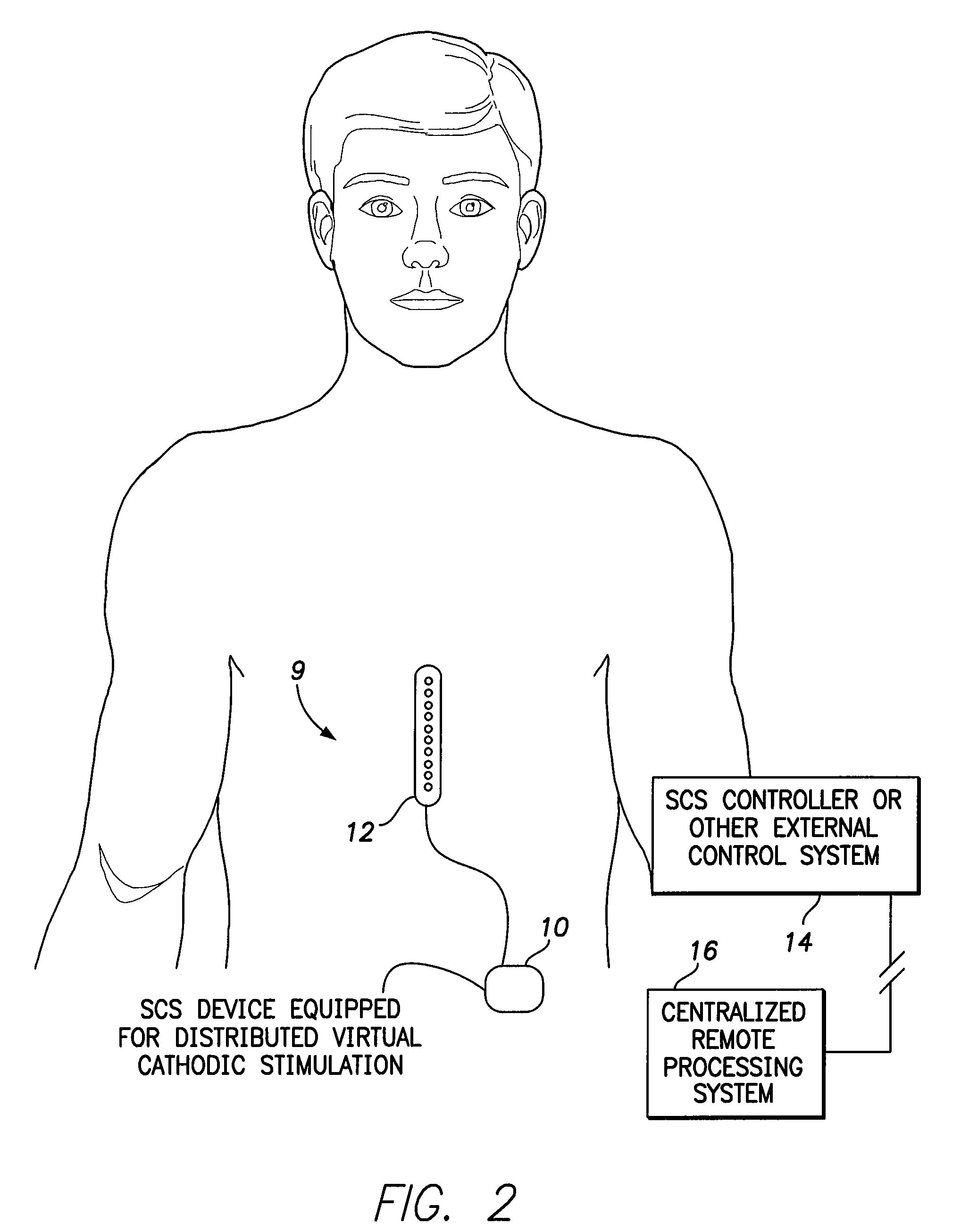 Systems and methods for providing a distributed virtual stimulation cathode for use with an implantable neurostimulation system