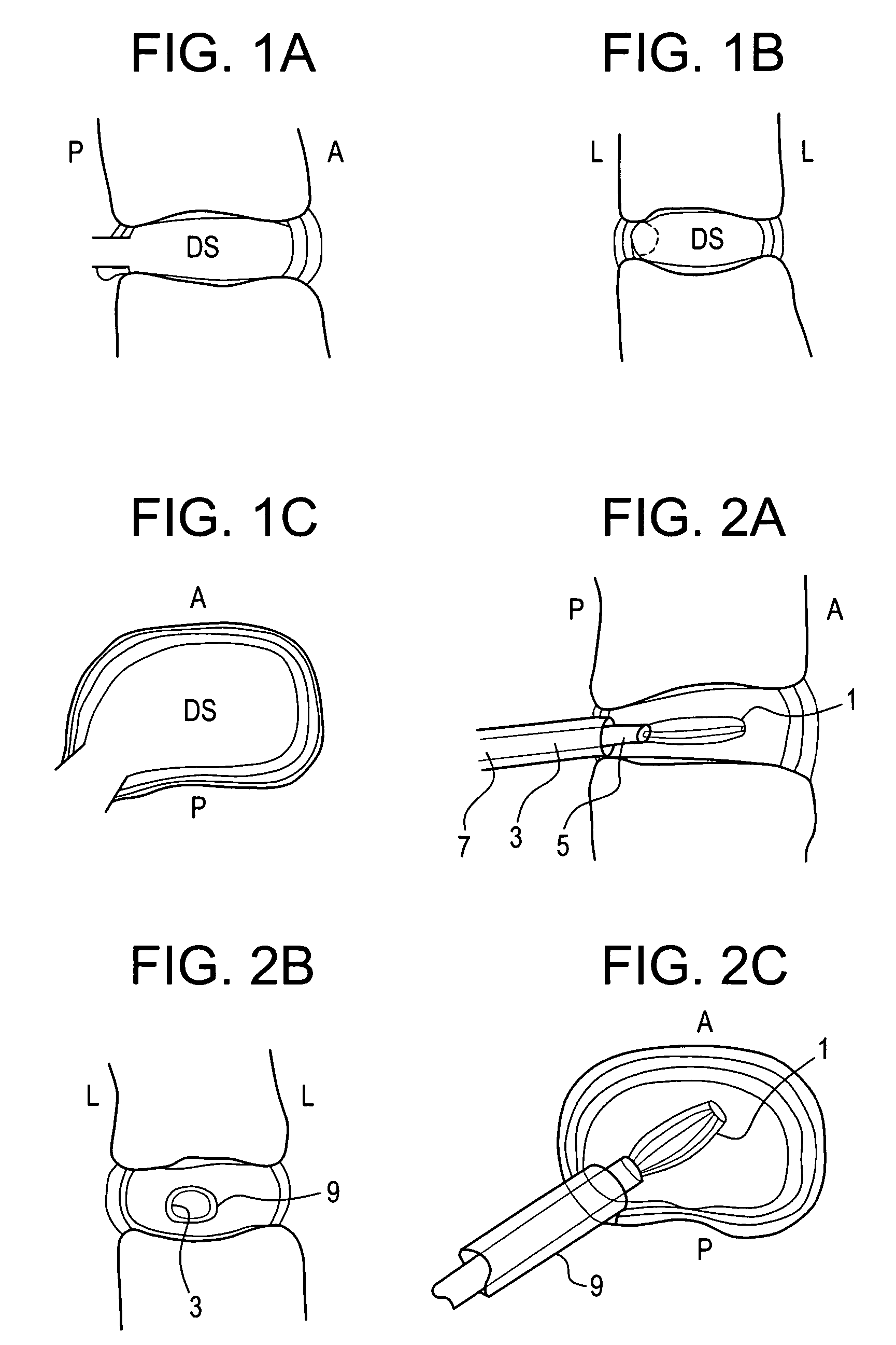 Nucleus pulposus trial device and technique