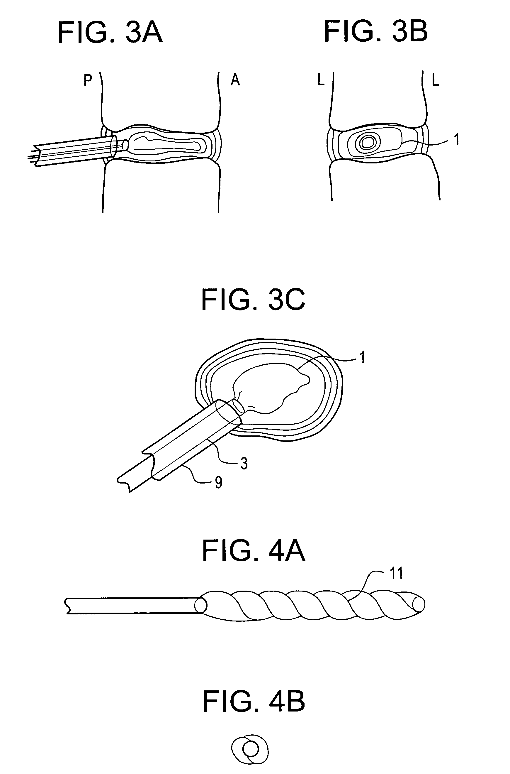 Nucleus pulposus trial device and technique