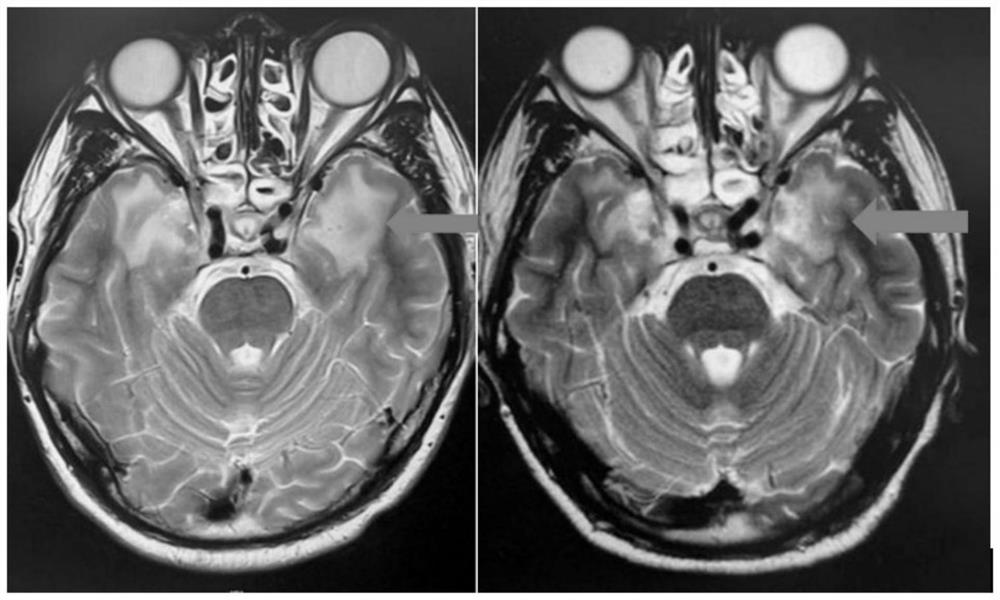 Applications of apatinib in preparation of drugs for preventing and treating radiation induced brain injury