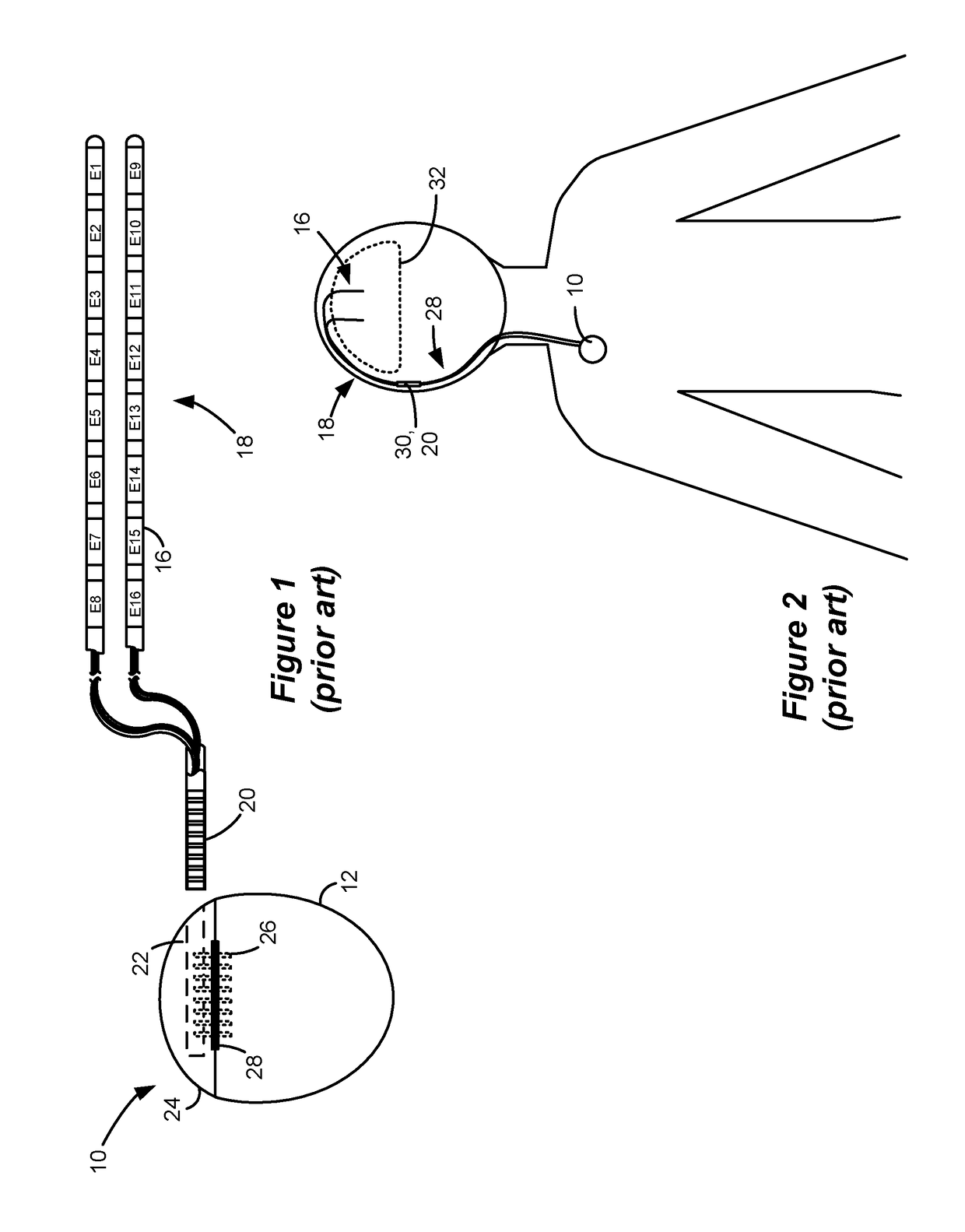 Skull-Mounted Deep Brain Stimulator