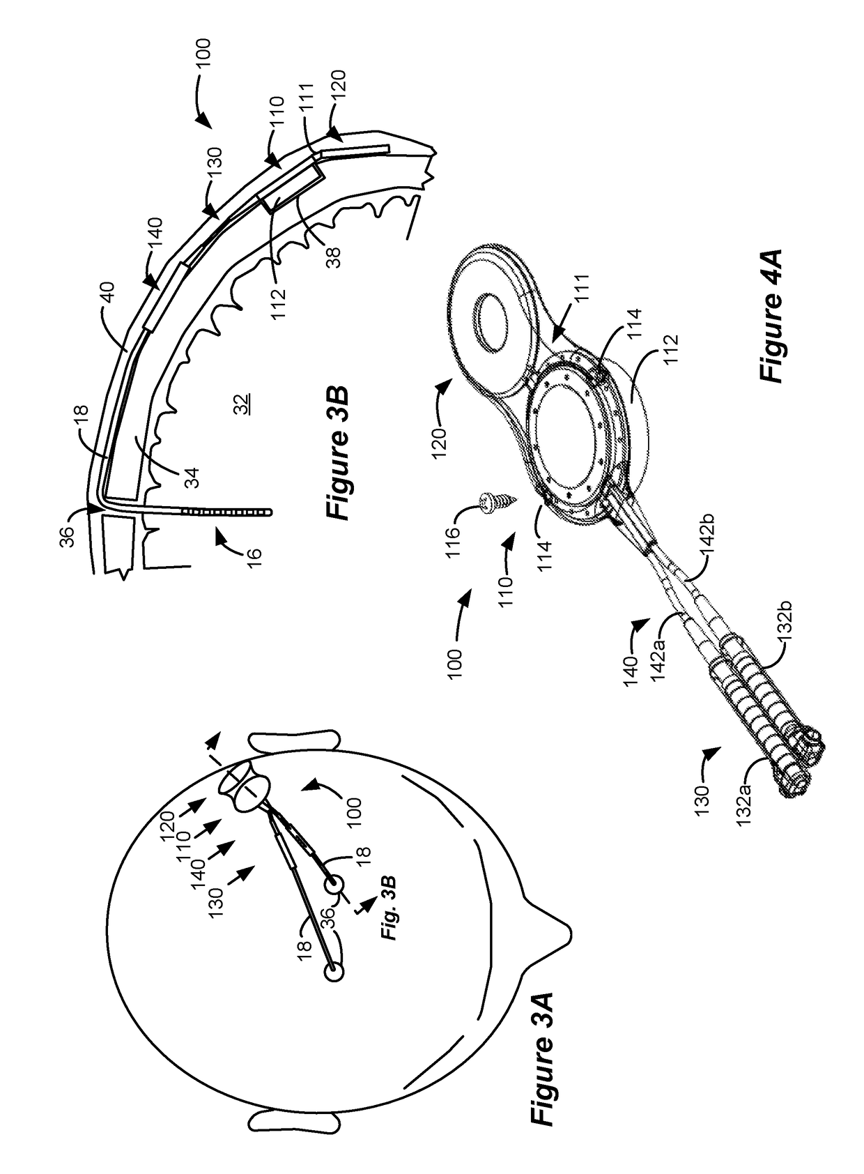 Skull-Mounted Deep Brain Stimulator