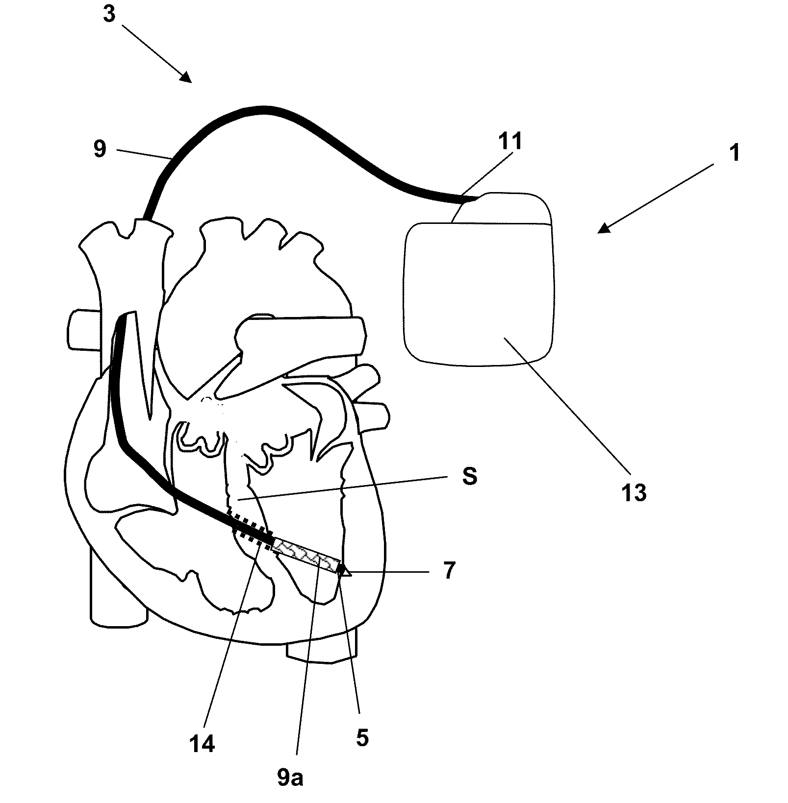 Implantable line