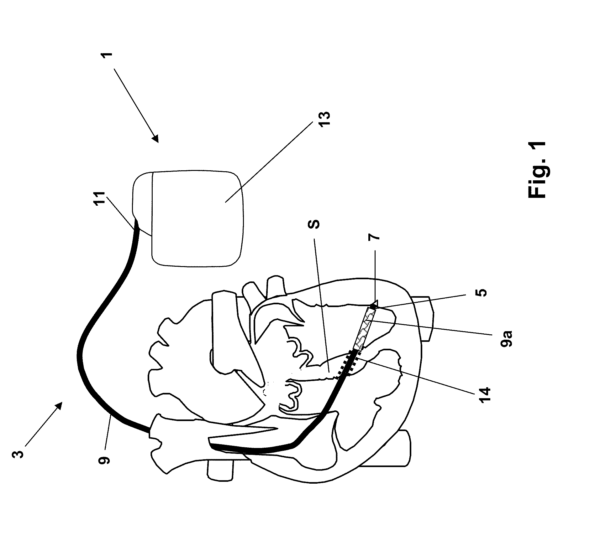 Implantable line