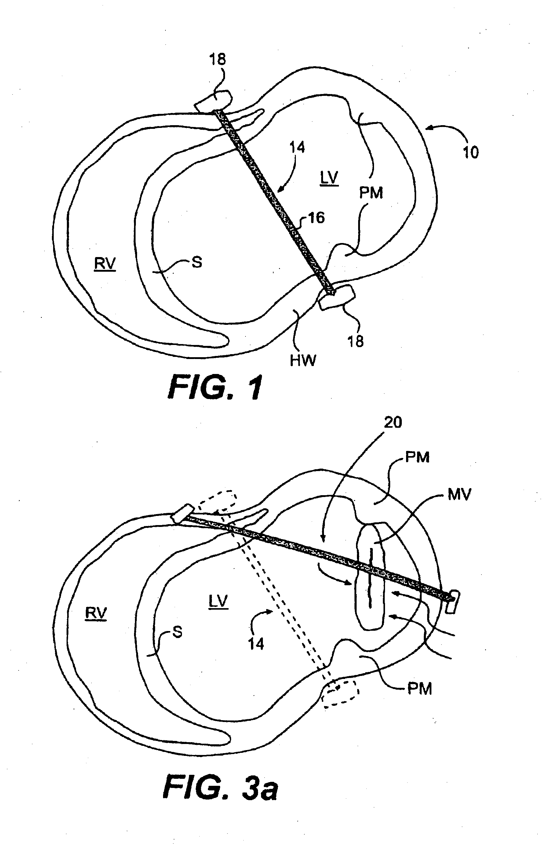 Methods and Devices for Improving Mitral Valve Function