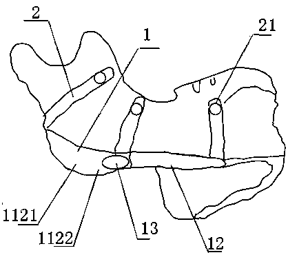 Human mandible osteotomy template