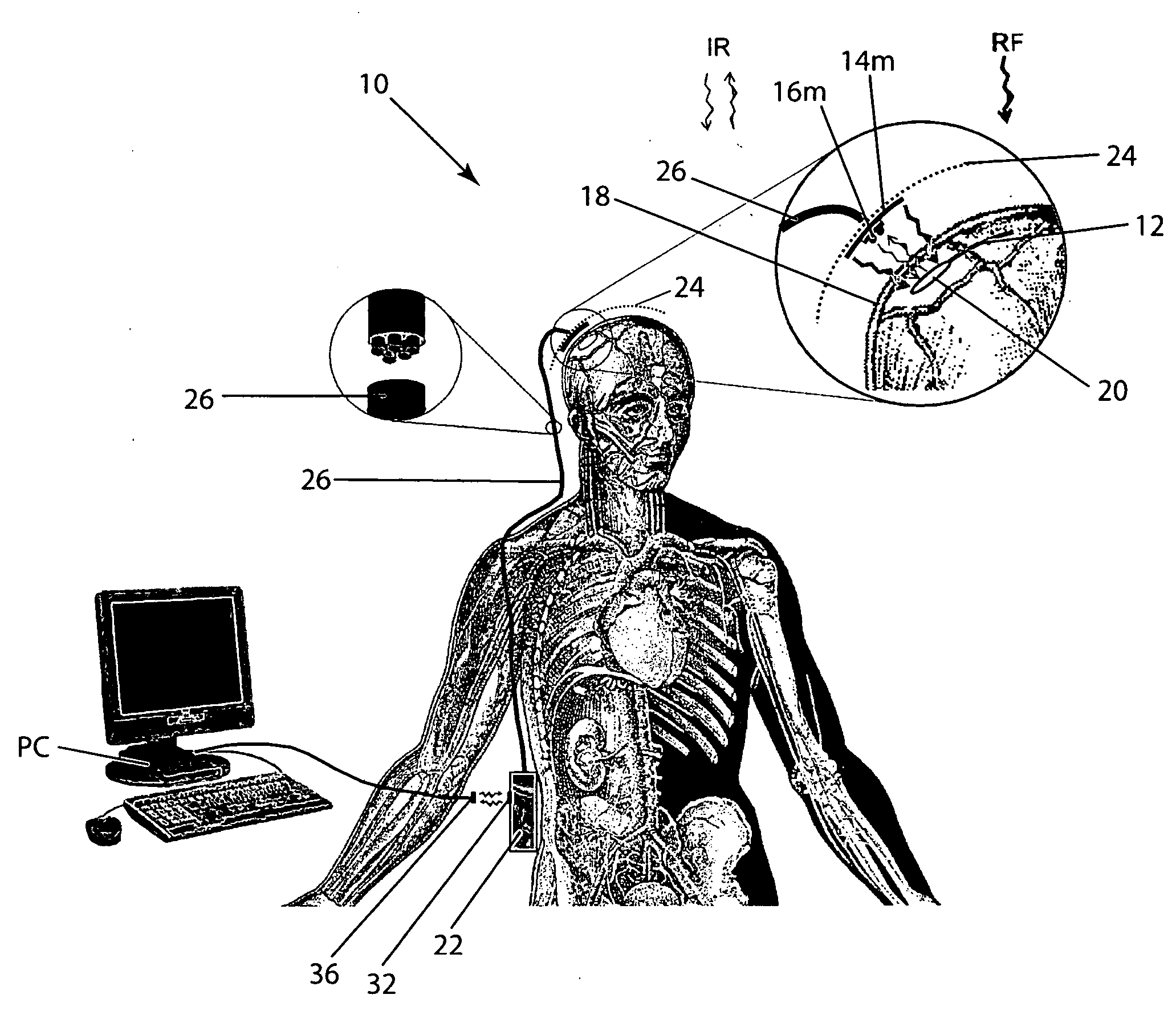 Wireless System for Epilepsy Monitoring and Measurement