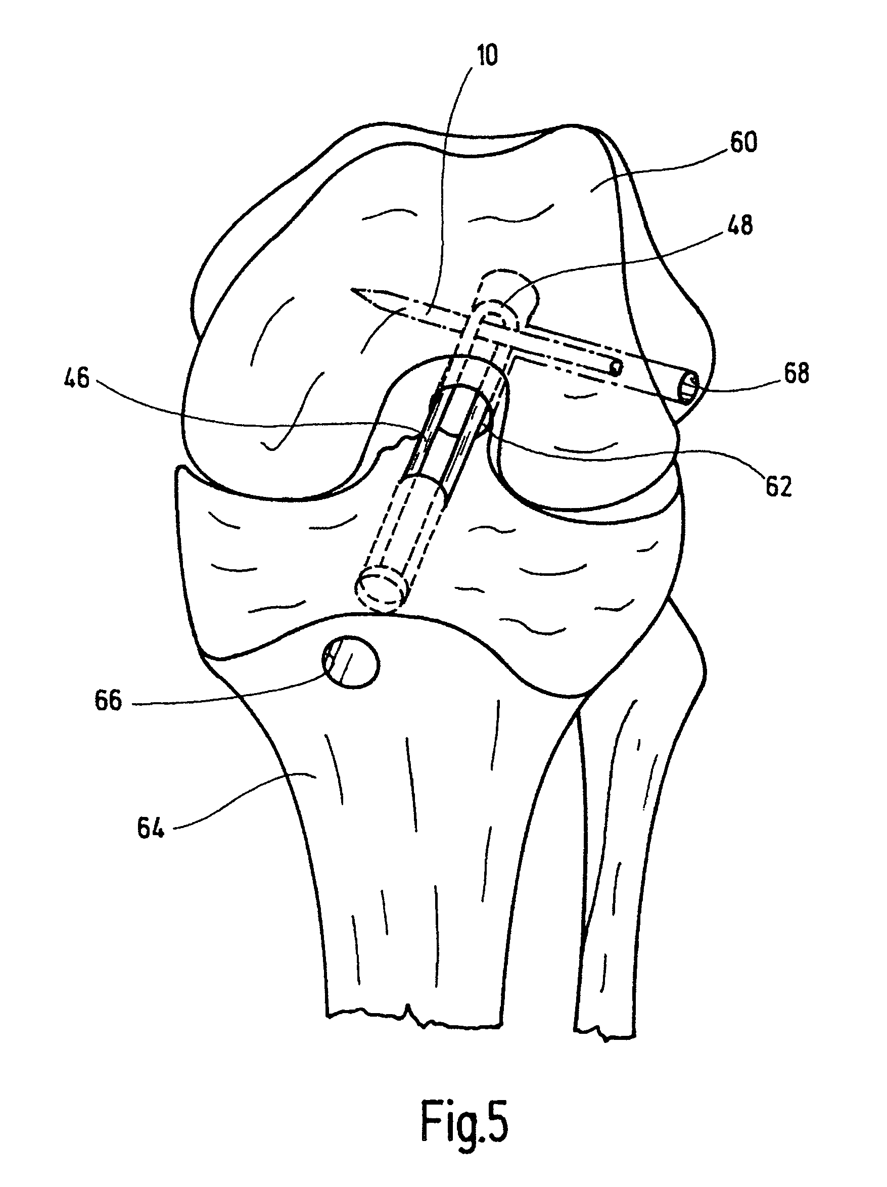 Pin for fixing an implant subjected to tensile load