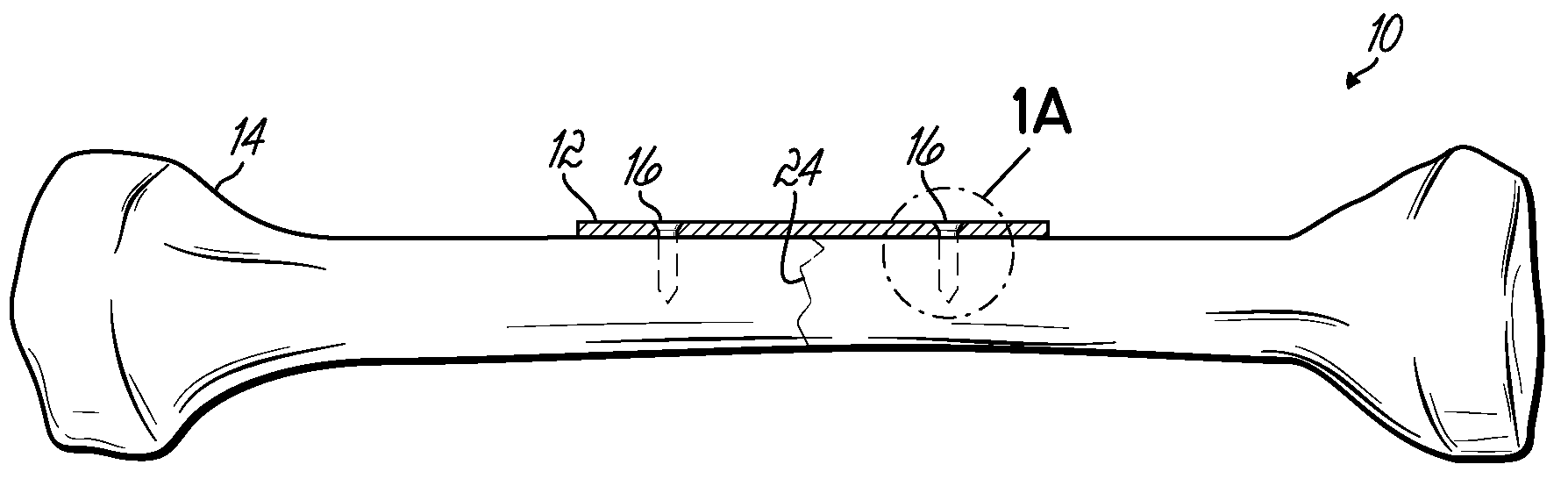 Bone fracture fixation system