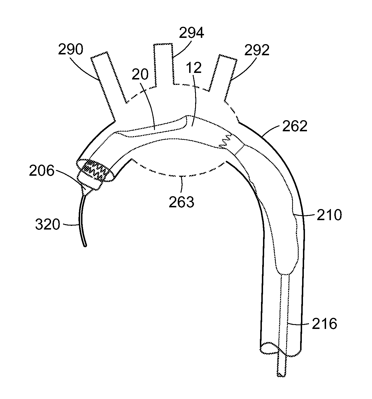 Device and method for aortic branched vessel repair