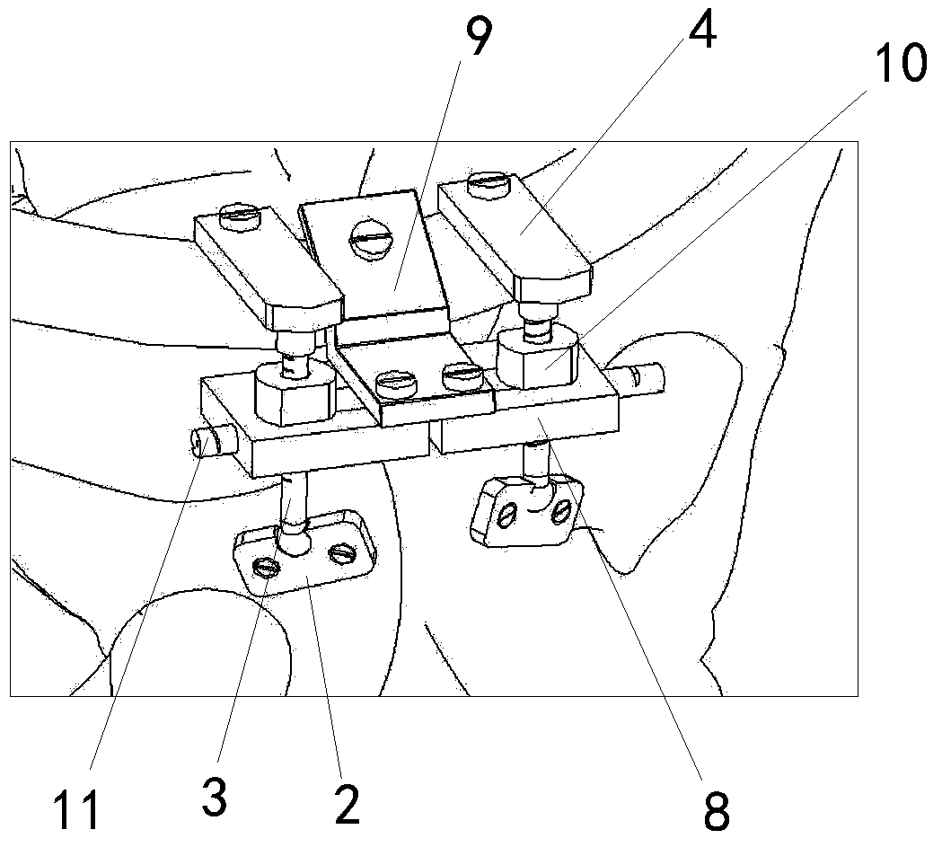 Pelvis tensioner