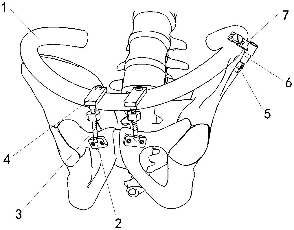 Pelvis tensioner