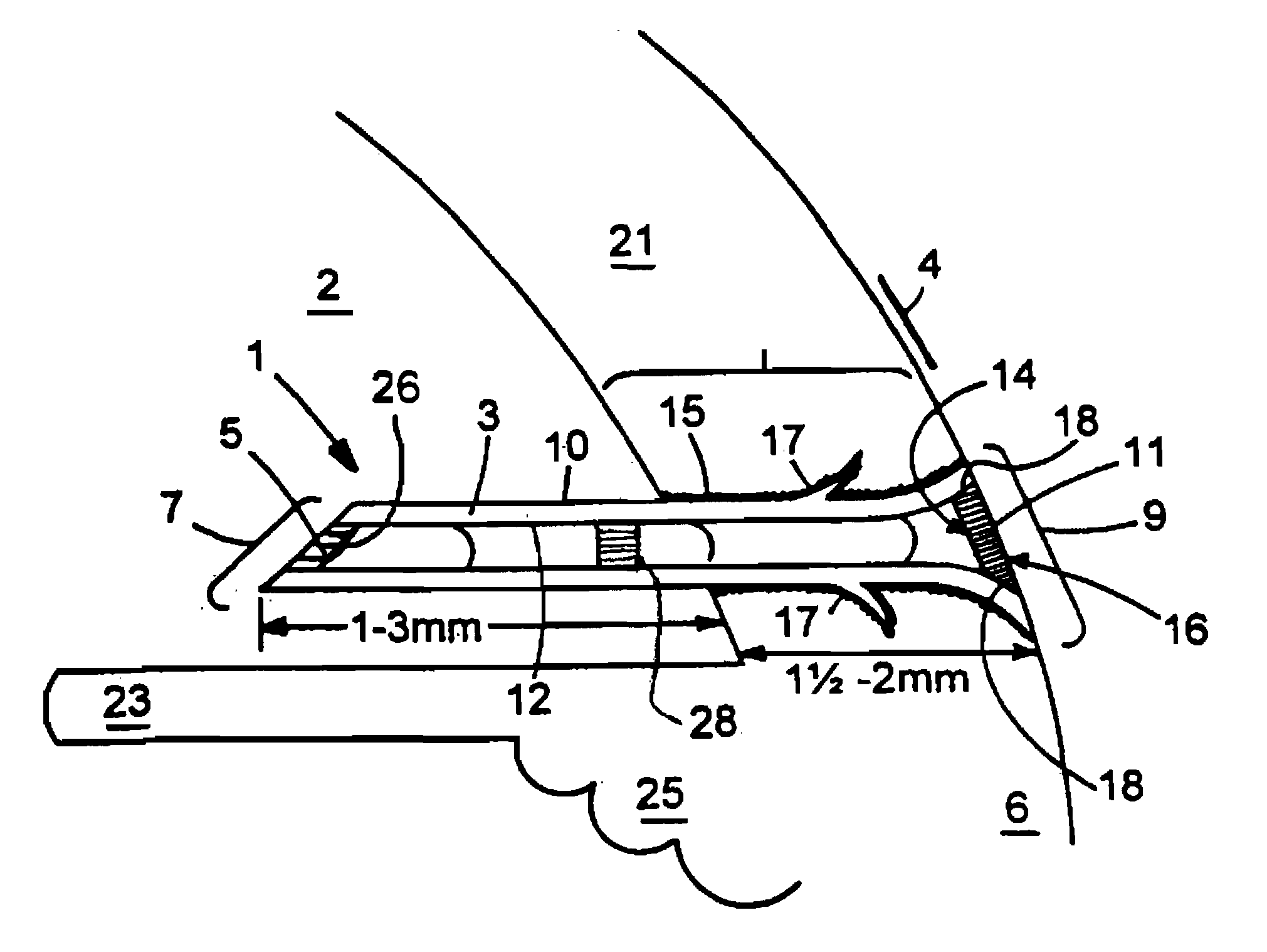 Glaucoma Treatment Devices and Methods