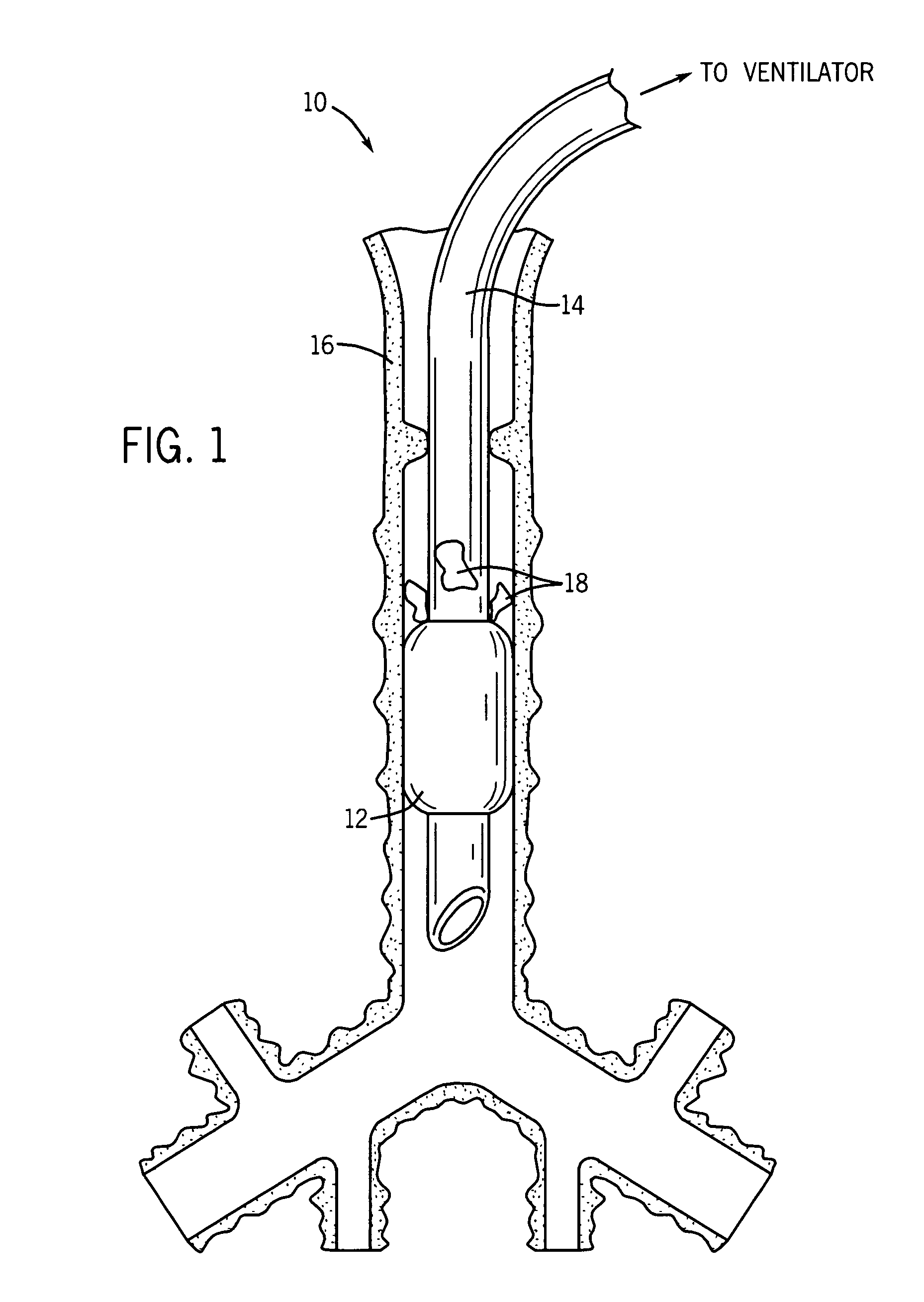 Endotracheal cuff and technique for using the same