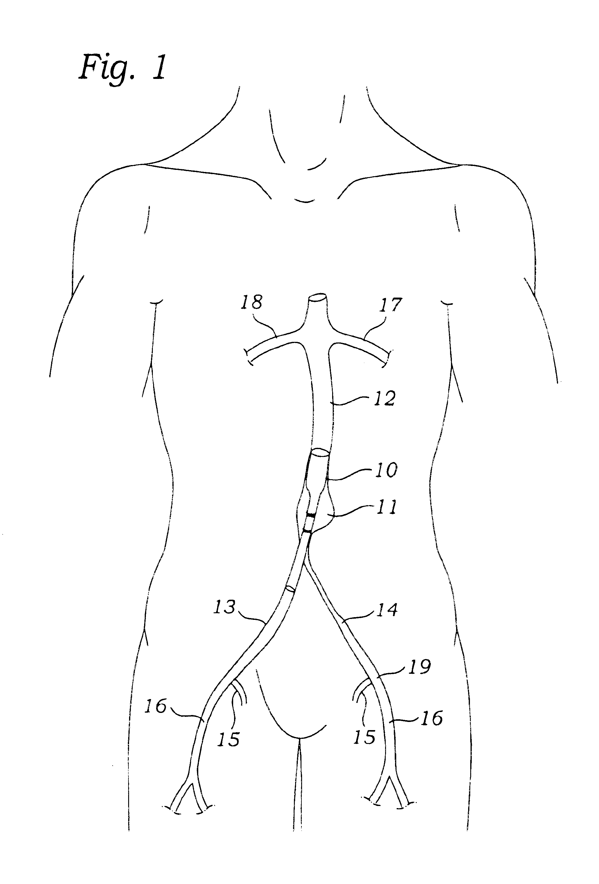 Aorto uni-iliac graft