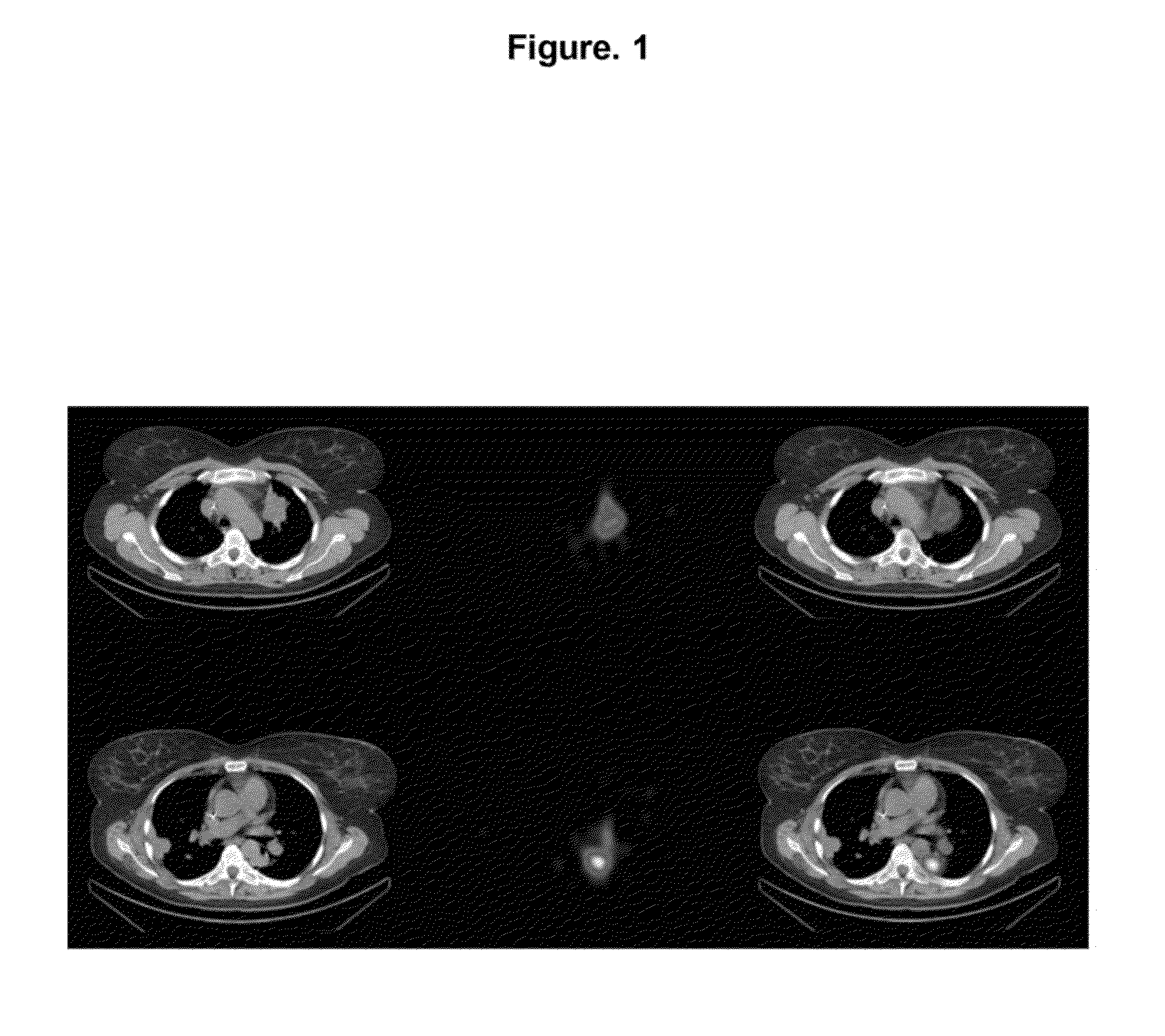 Method for Treating Lung Carcinoma