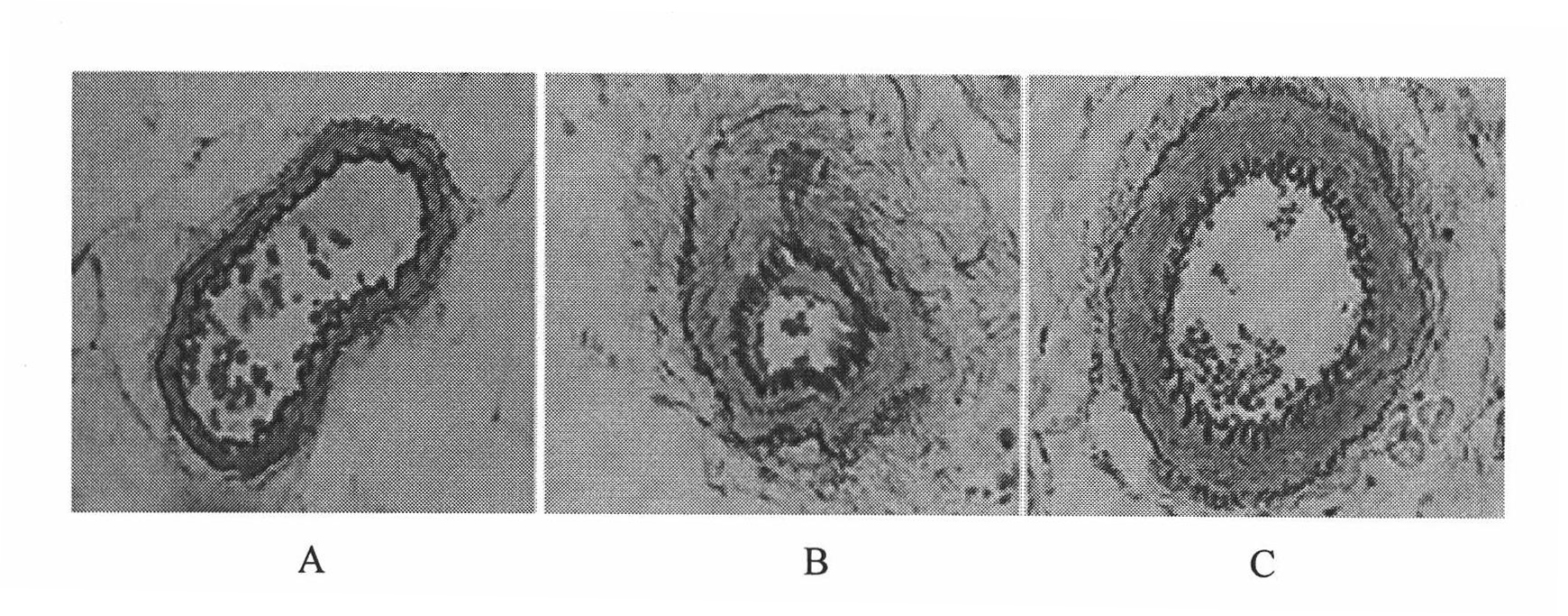 Medicament for preventing and treating small intestine transplantation chronic rejection and application thereof