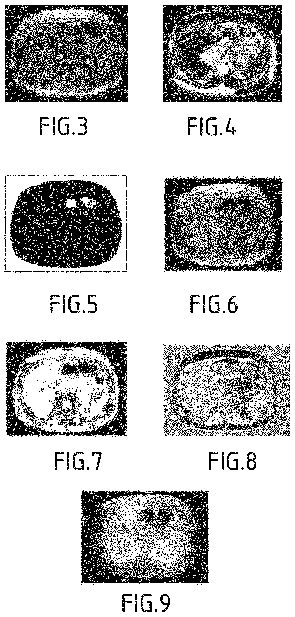 A method for post-processing liver MRI images to obtain a reconstructed map of the internal magnetic susceptibility