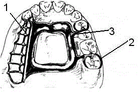 A kind of pure titanium removable denture bracket with vitaline clasp and preparation method thereof