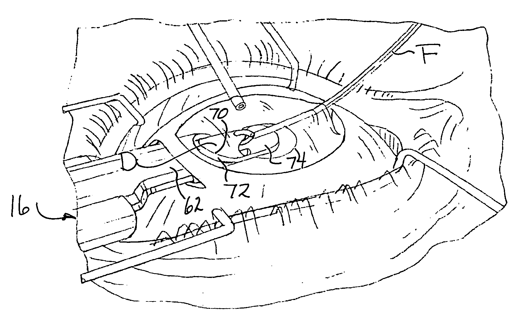 System and method for descemet's stripping automated endothelial keratoplasty (DSAEK) surgery